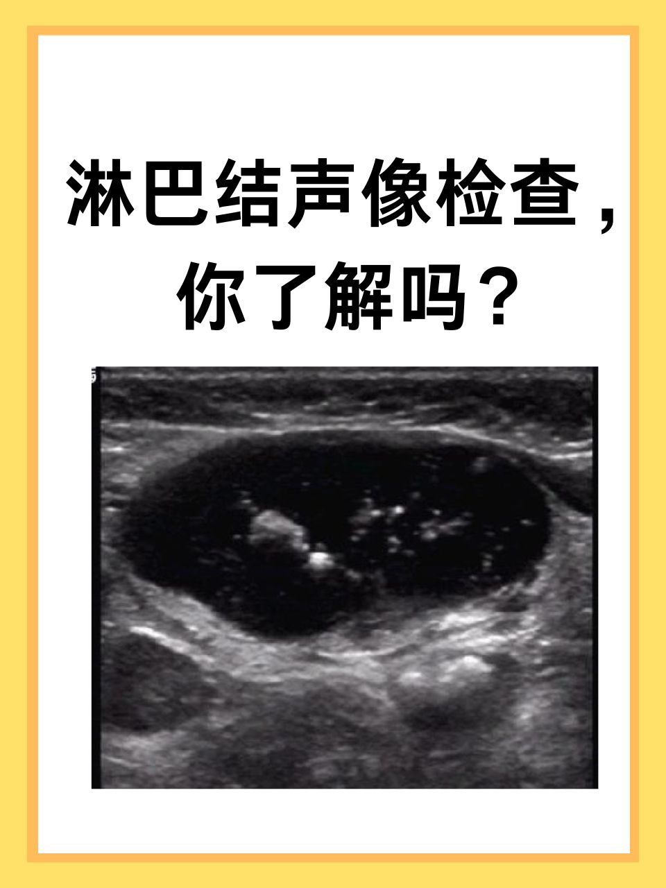 淋巴结声像检查,你了解吗?