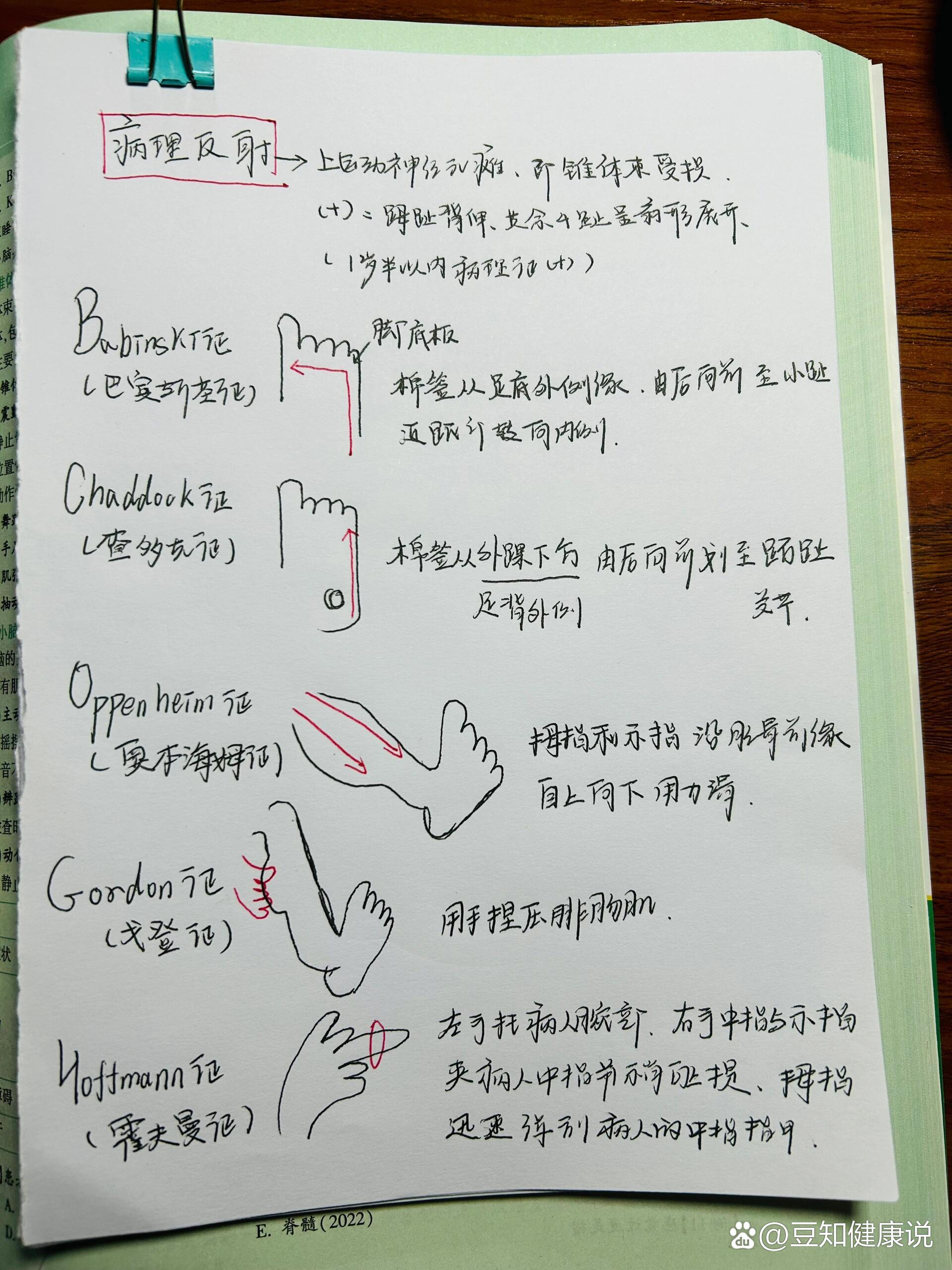 巴宾斯基反射又称图片