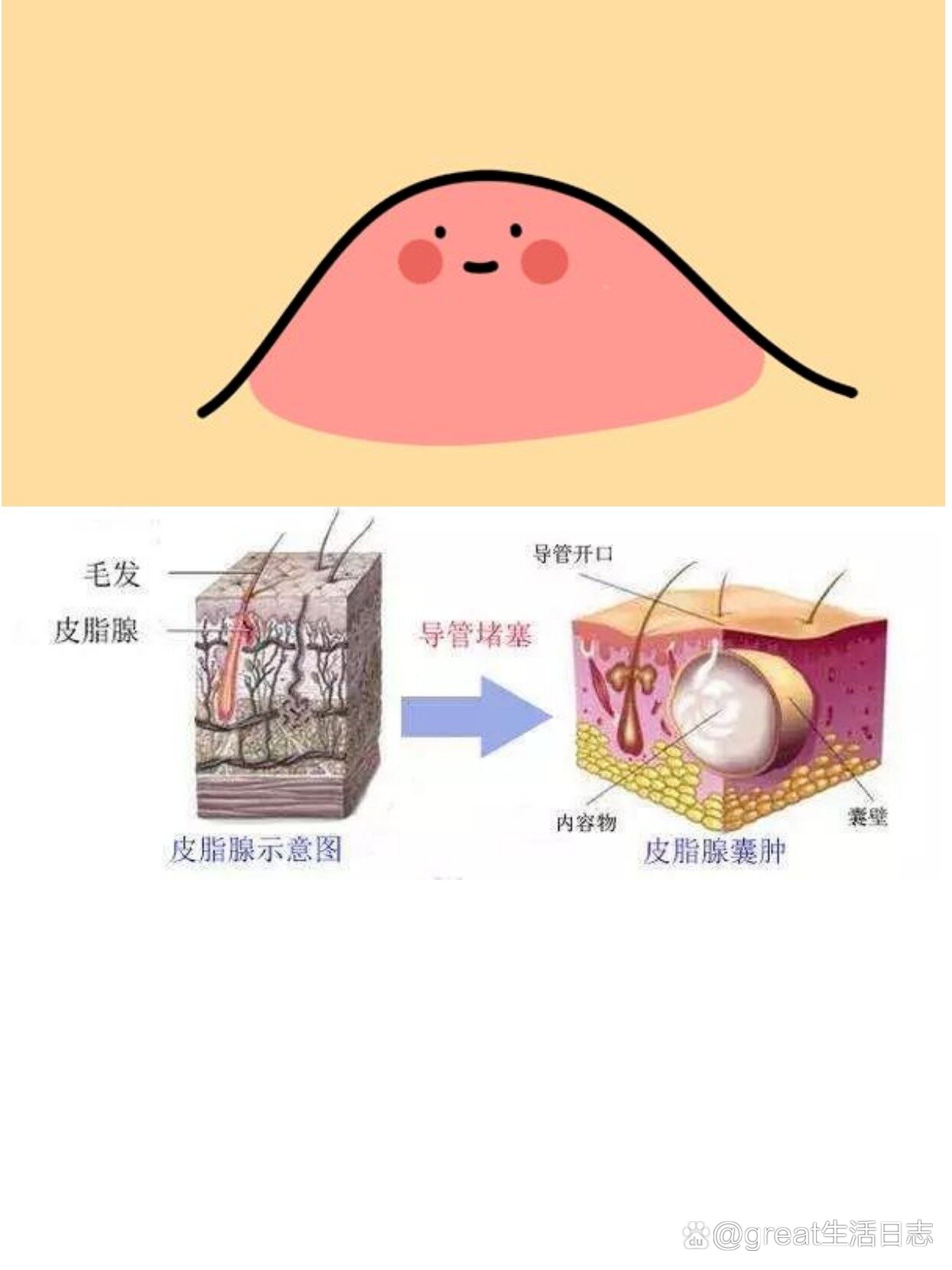 腺囊肿,该怎么办6315 br>1156602 皮脂腺囊肿俗称"粉瘤",但