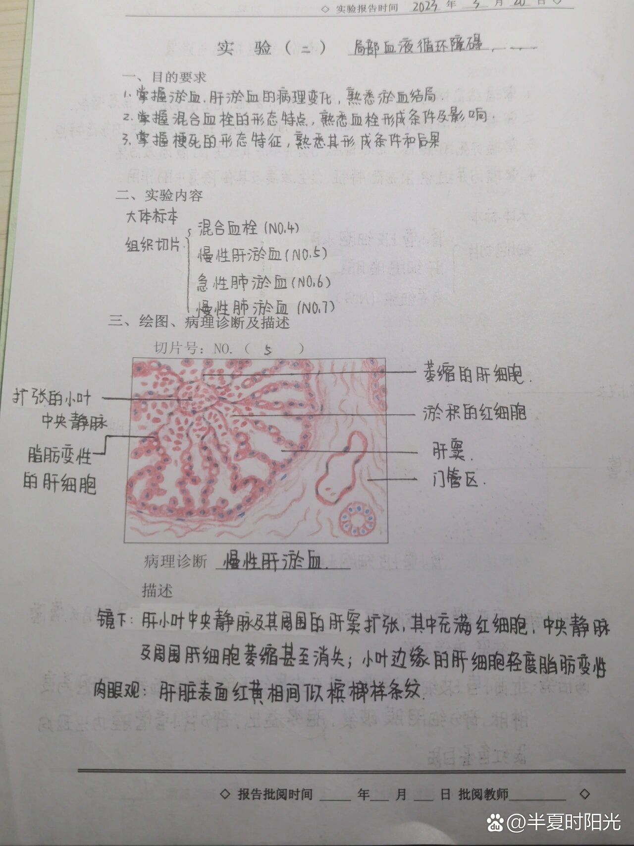 慢性肝淤血,槟榔肝