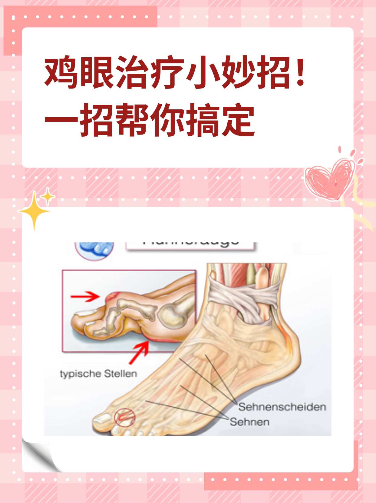 鸡眼怎么去除最好方法图片