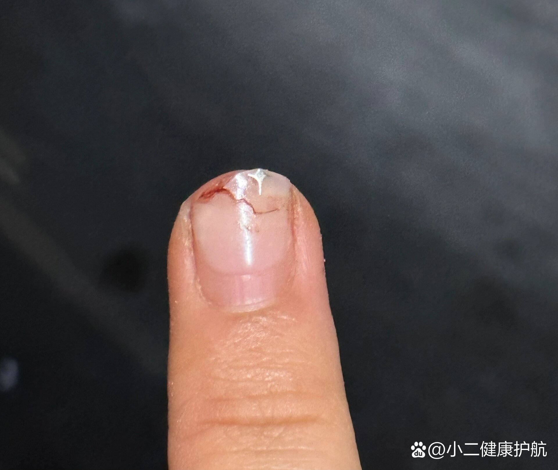 指甲断裂了需要全部剪掉吗?