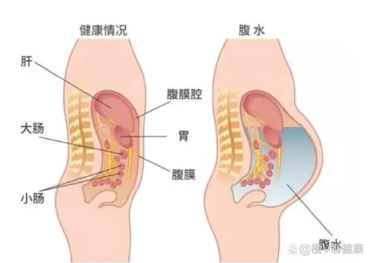 怎样判断是否腹部积水图片