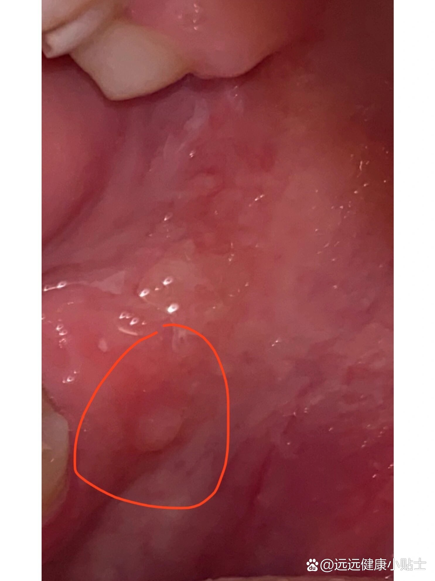 口腔里反复长这个小疙瘩