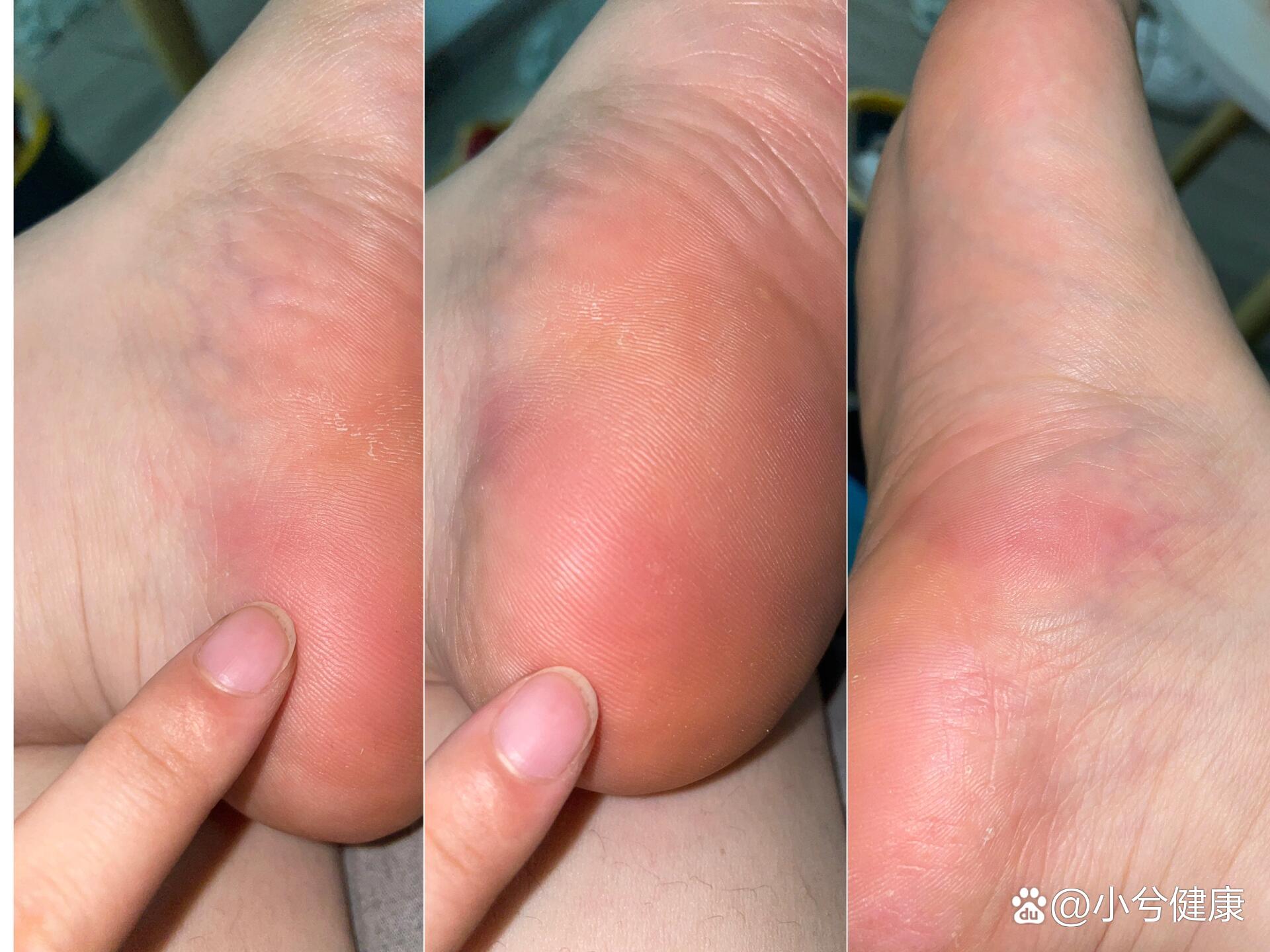 19-10.24脚疼没好