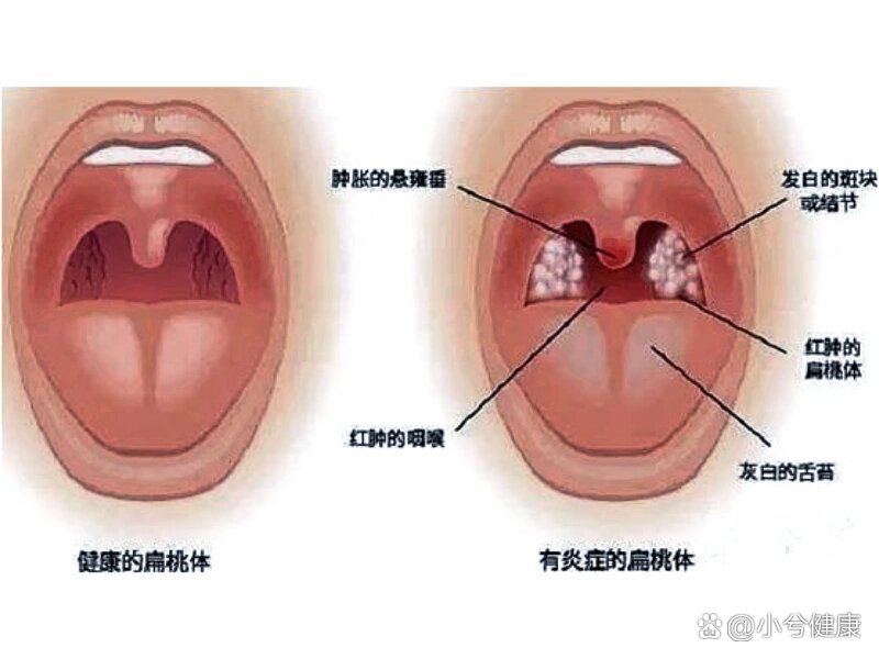 咽炎与正常的图片