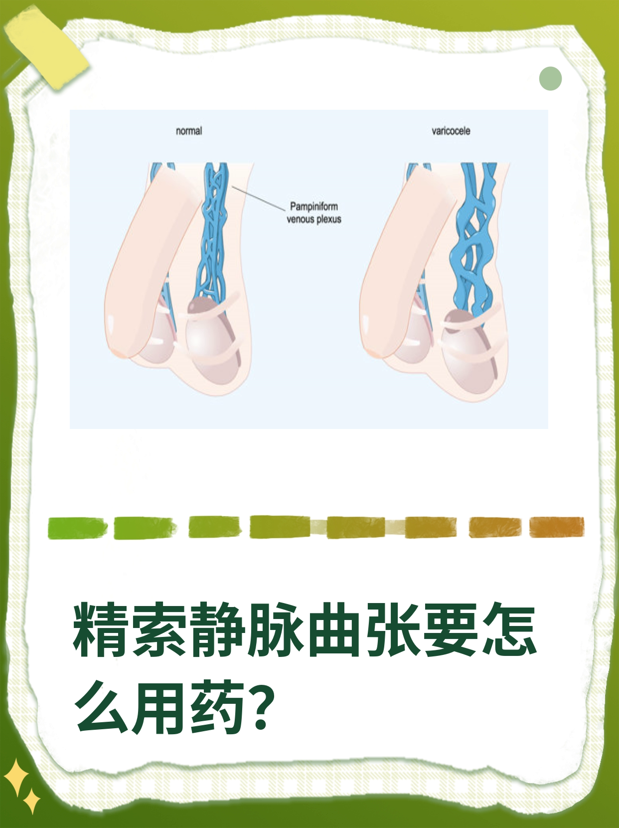 精索静脉曲张阴囊照片图片