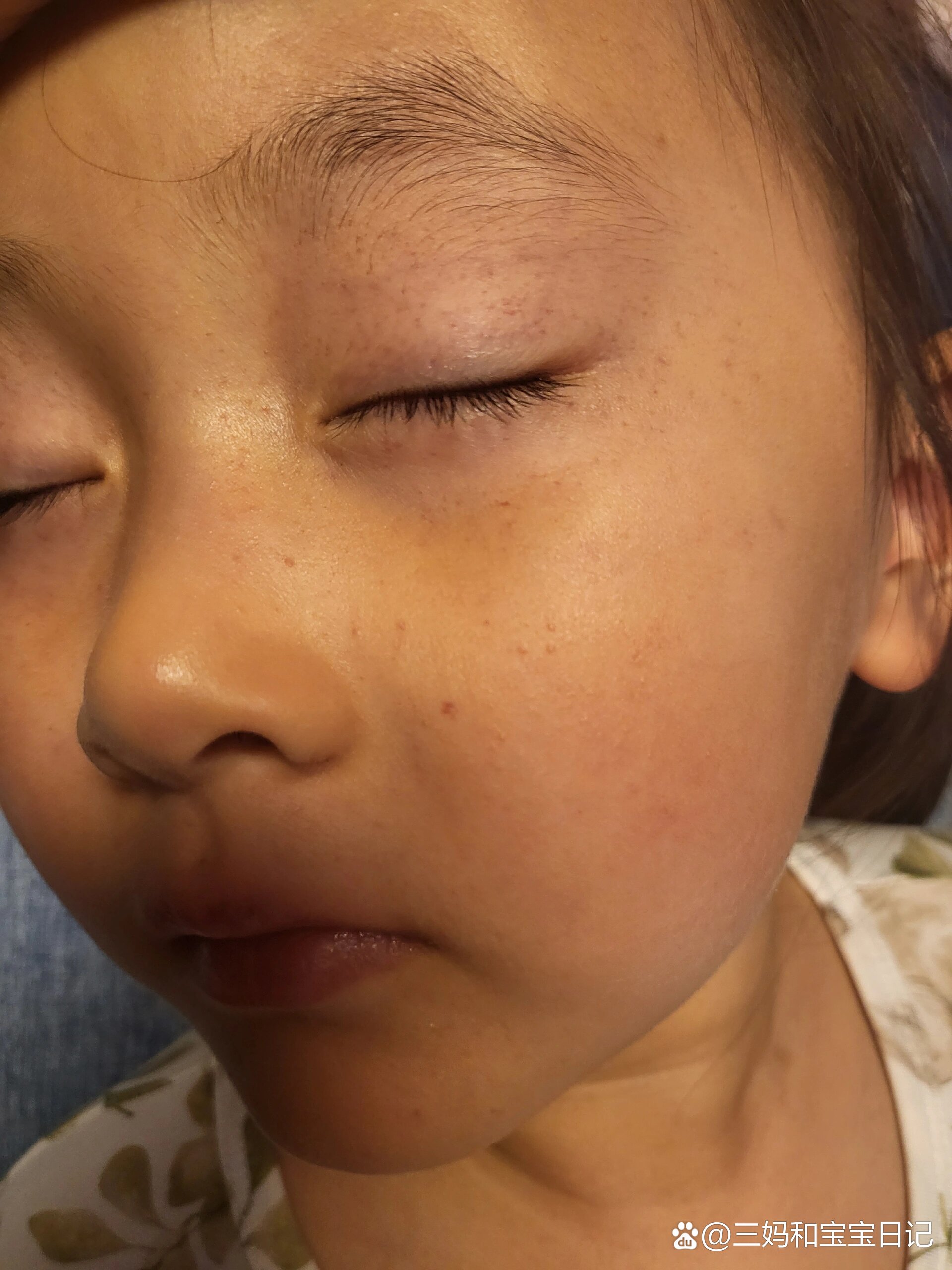 孩子眼皮上下起了的小红点,什么原因