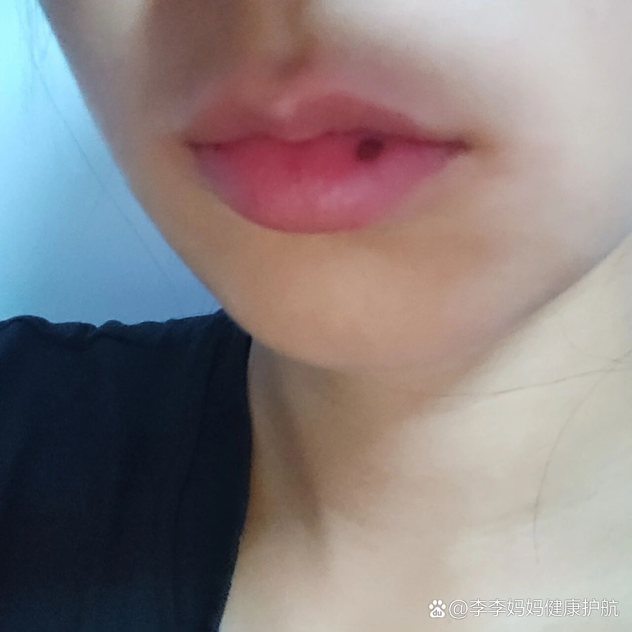 嘴唇上起了个黑点