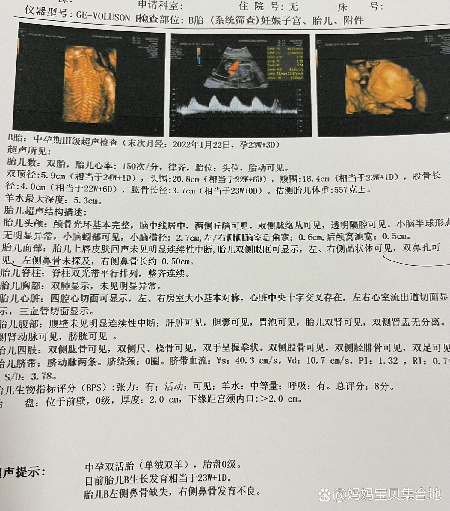 婴儿鼻骨发育不良图片图片