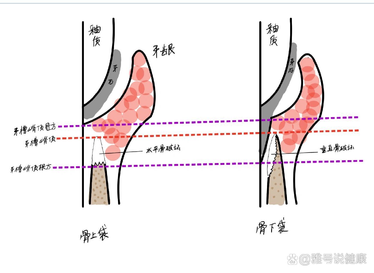 骨上袋与骨下袋