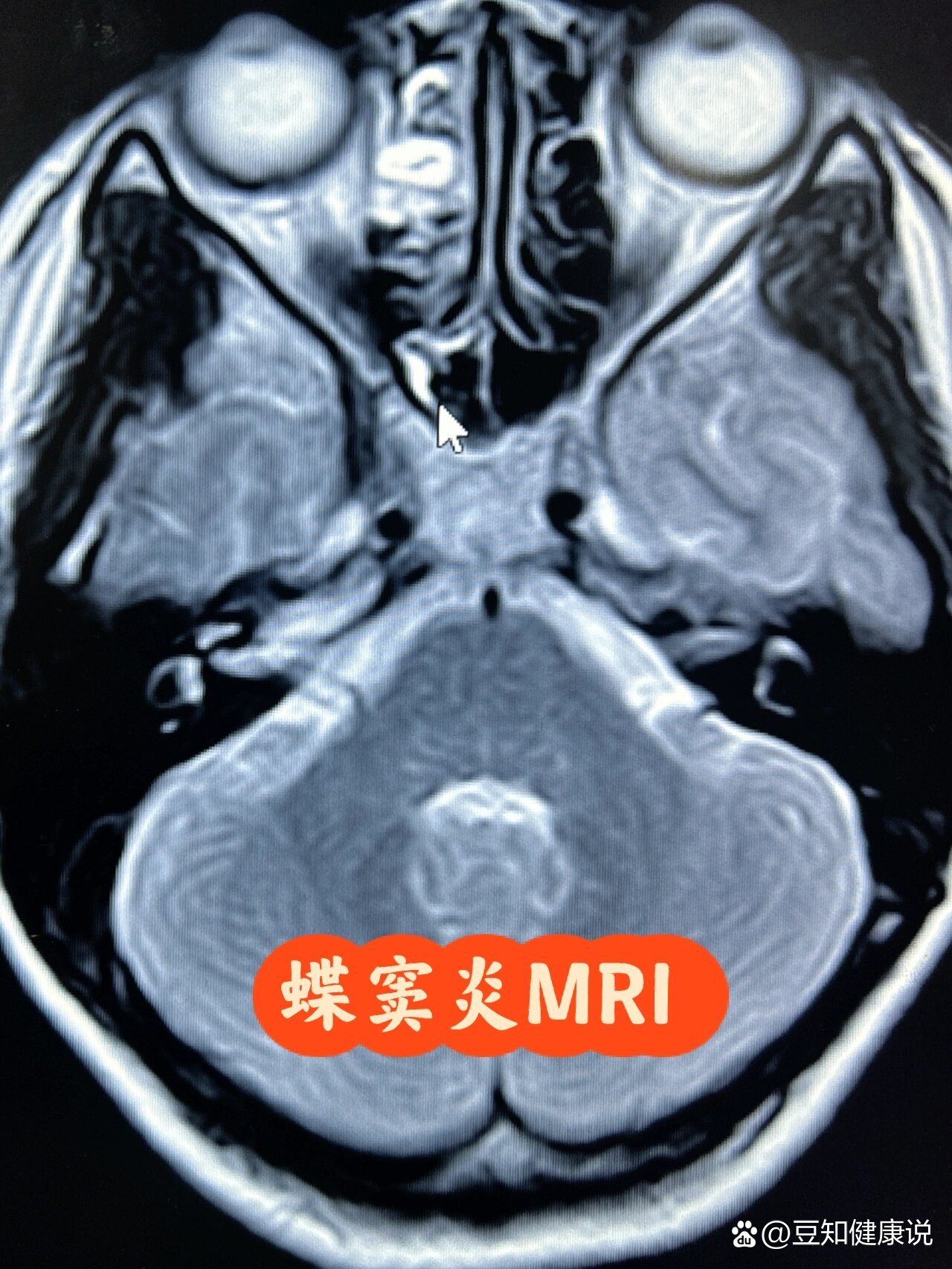 蝶窦癌图片