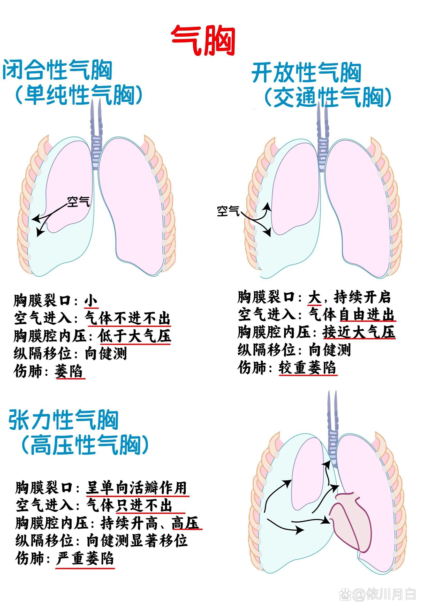 三种气胸的图片图片