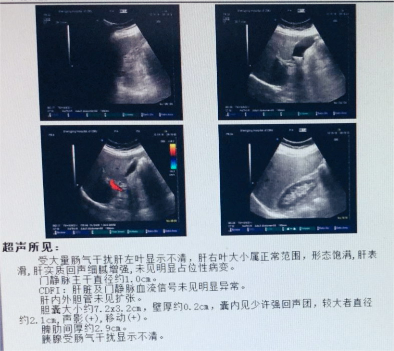 胆囊炎的治疗费用及手术过程