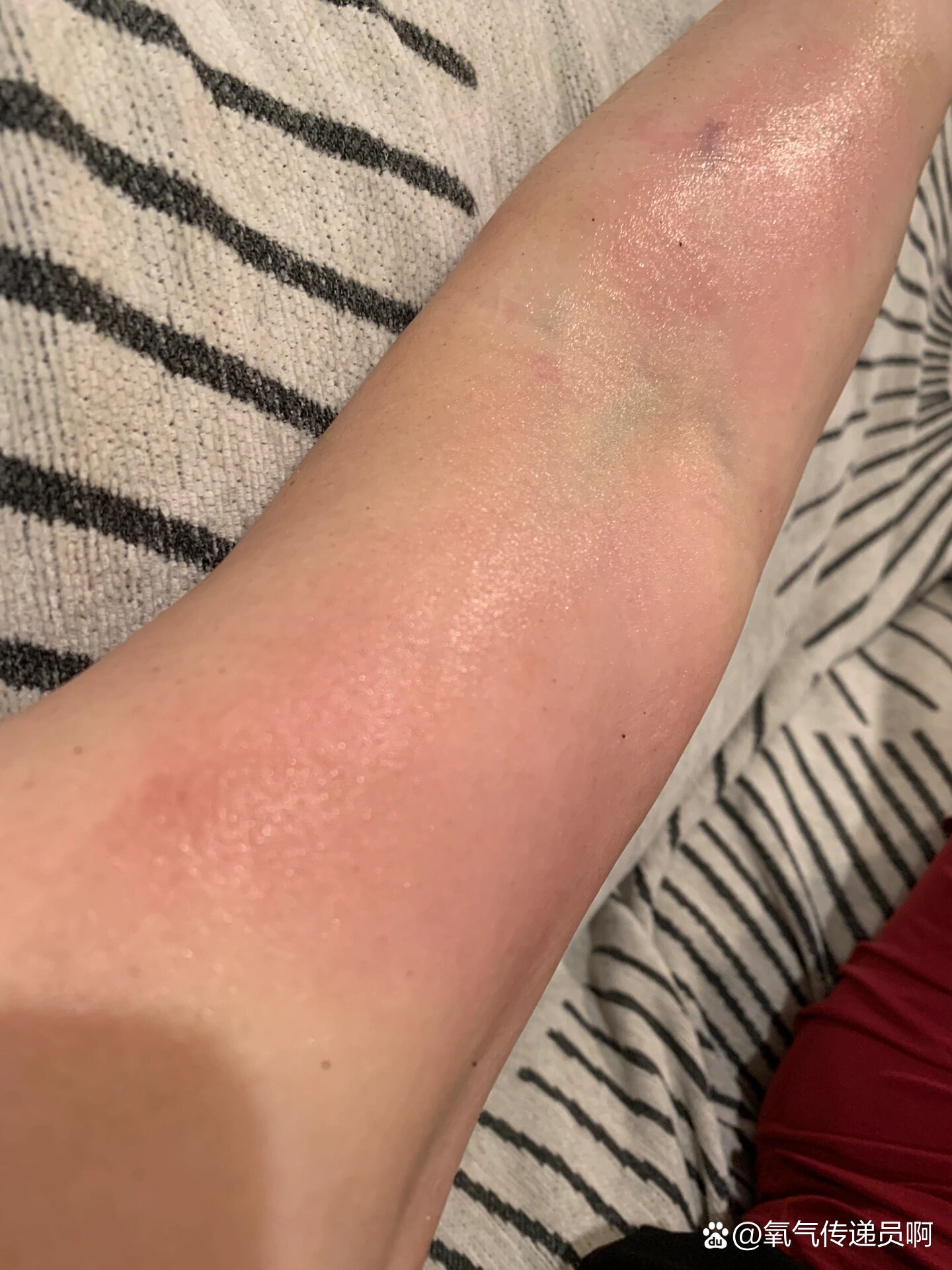 烫伤后什么时候长水泡?