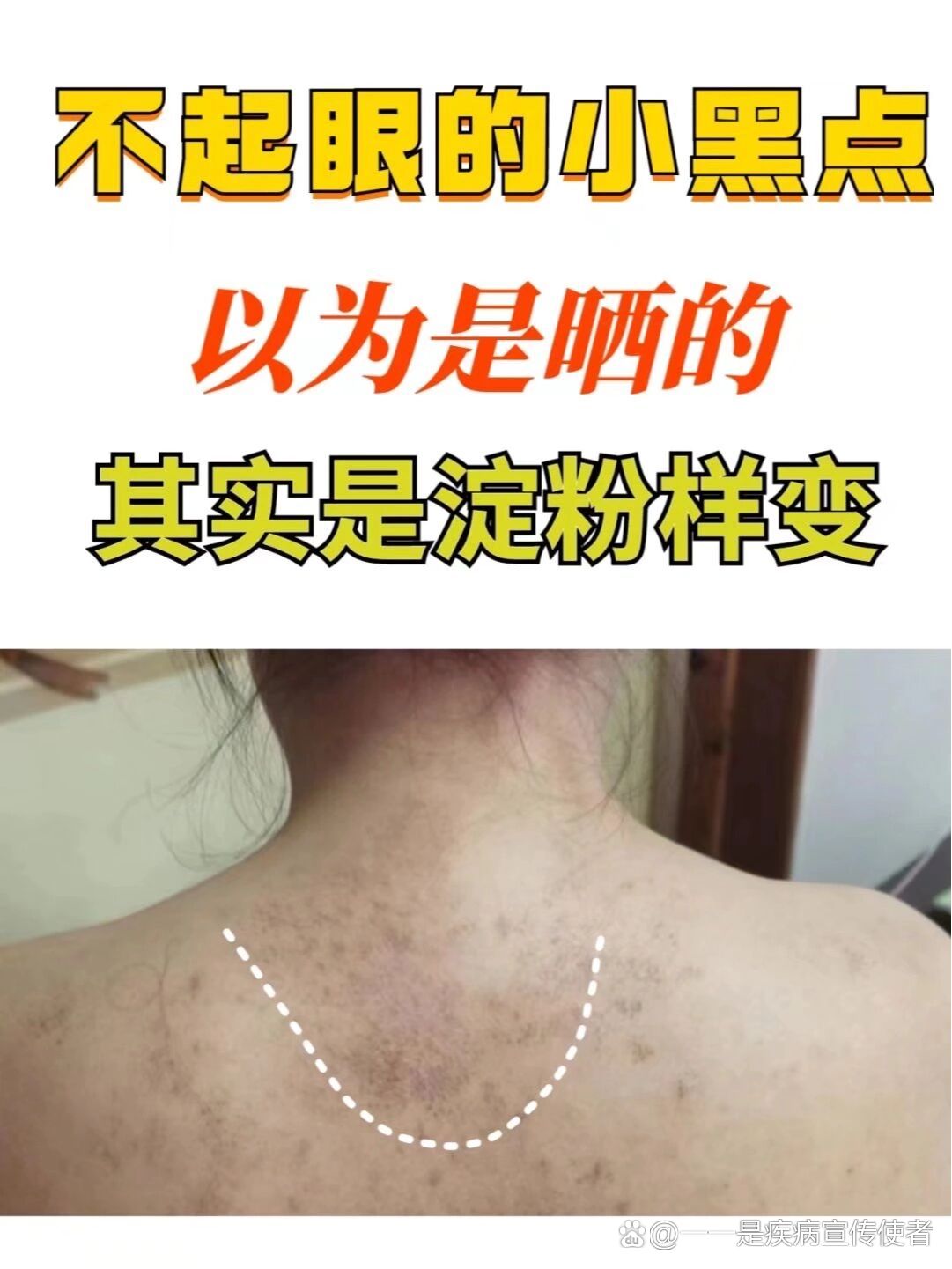 不起眼的小黑点,其实是淀粉样变!