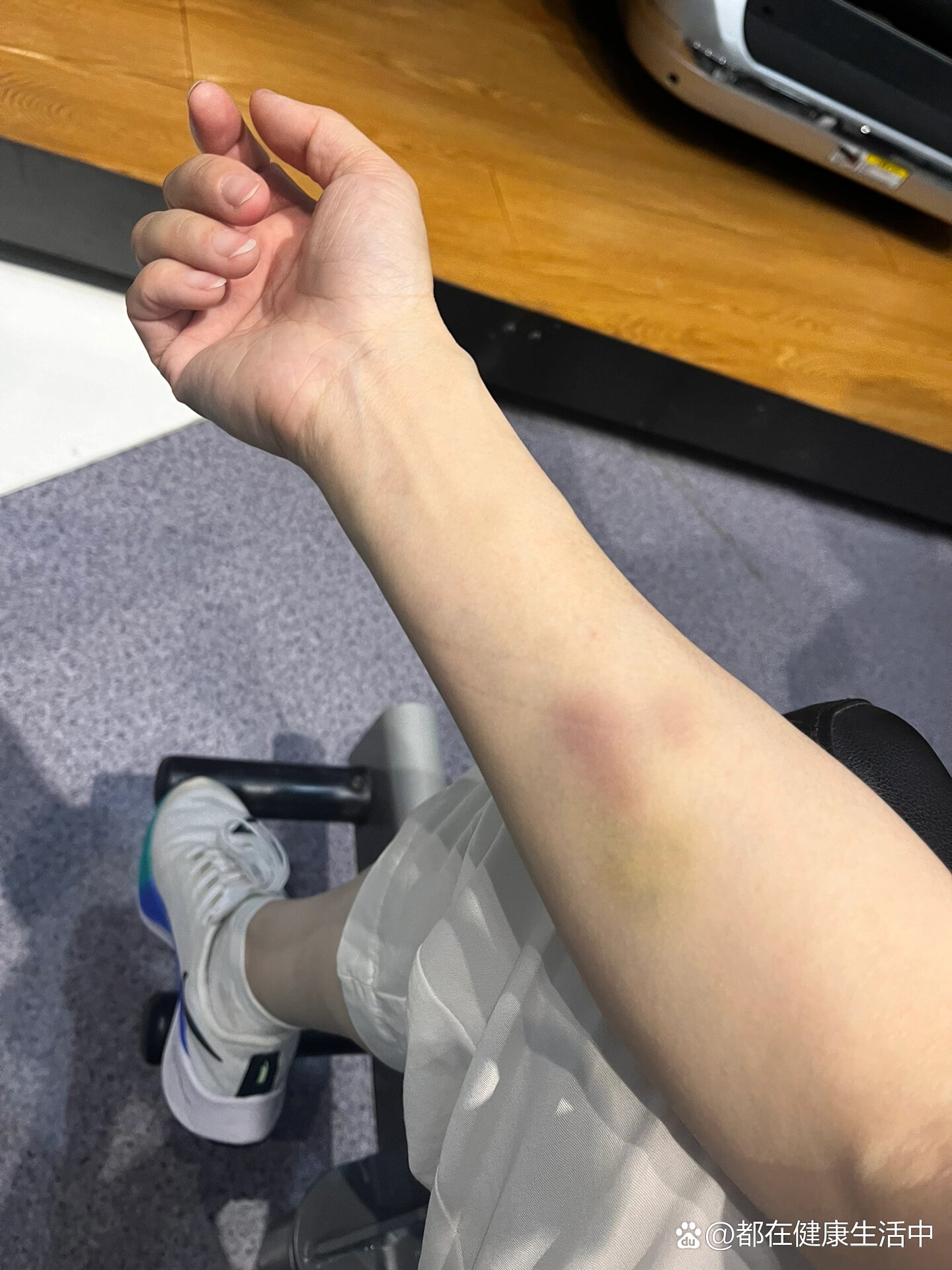 胳膊上莫名其妙的淤青