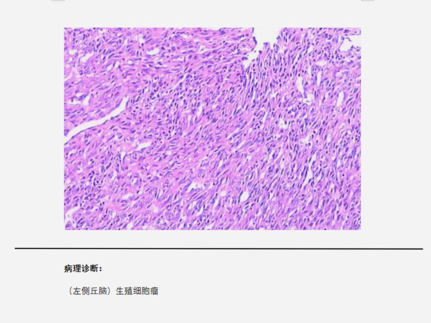 生殖细胞肿瘤 全网资源