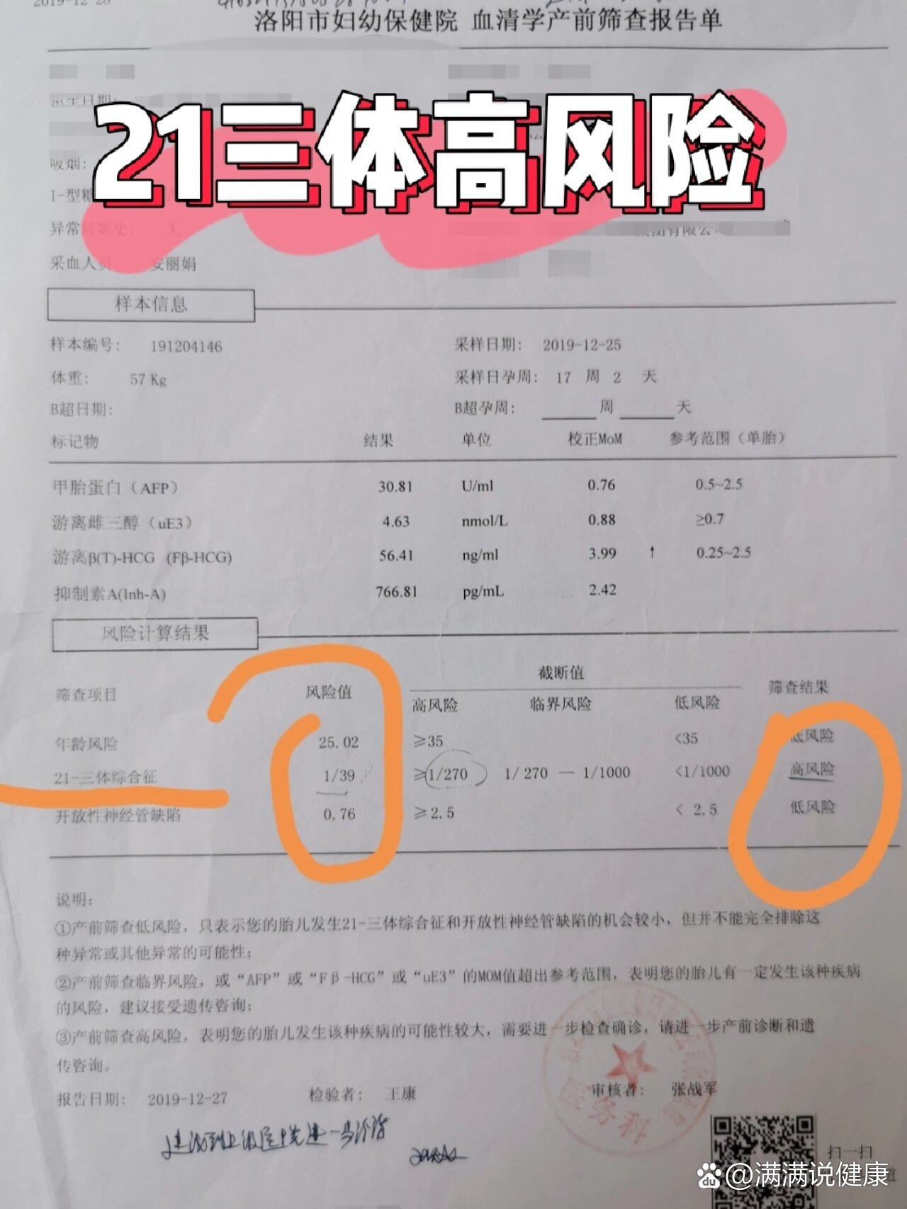 唐筛21三体高风险