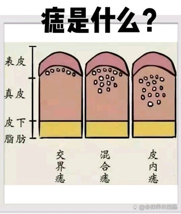 点痣为什么会留坑图片