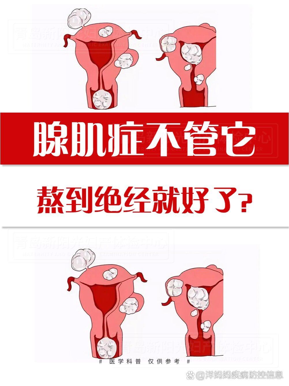 子宫腺肌症图片