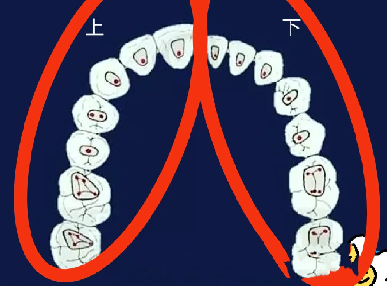 下颌六的开髓形态图片图片