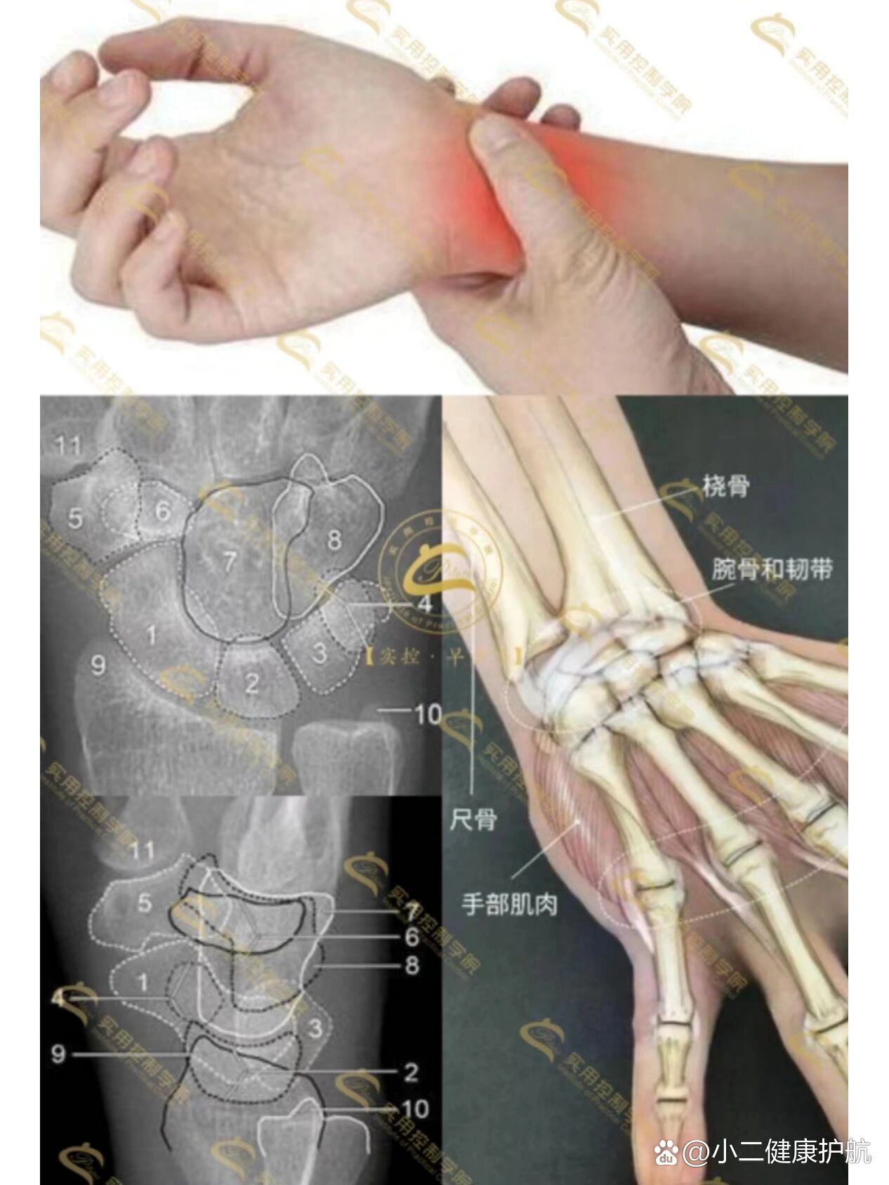 腕骨间关节图片