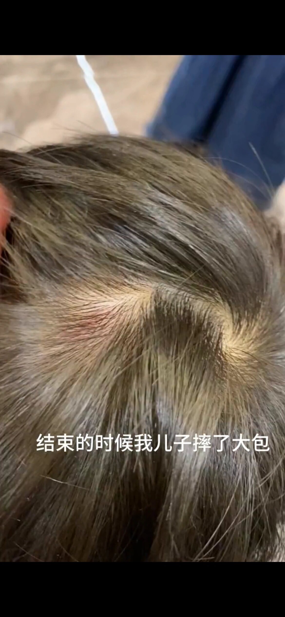 孩子头摔到大鼓包马上用茶油非常有效果