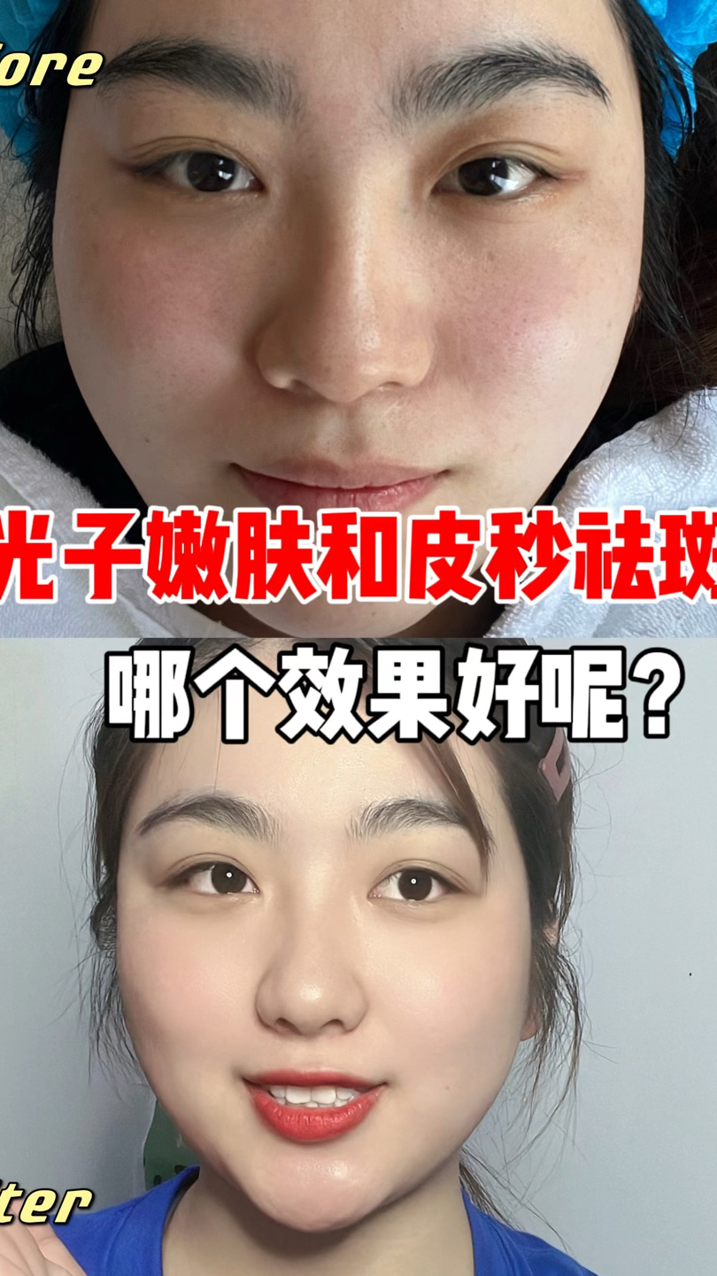 光子嫩肤和皮秒祛斑,到底哪个效果好呢?