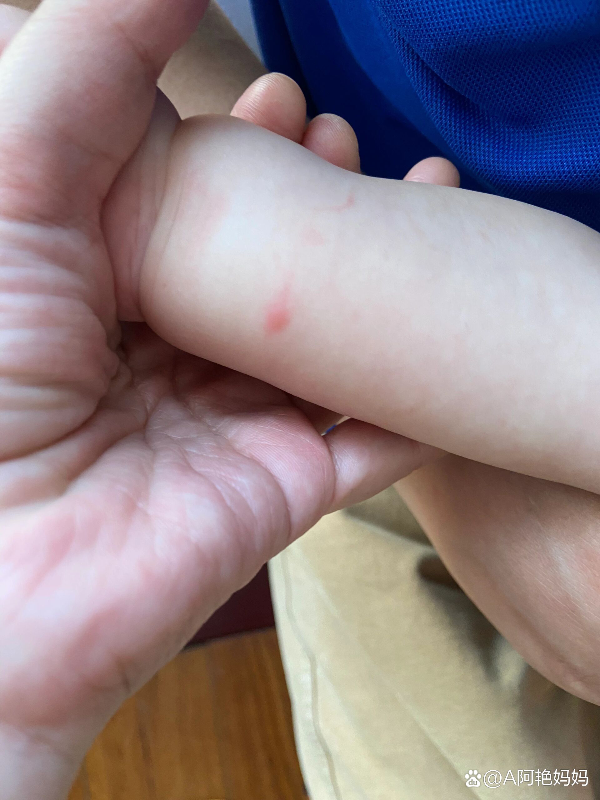 为什么被蚊子咬了起红点