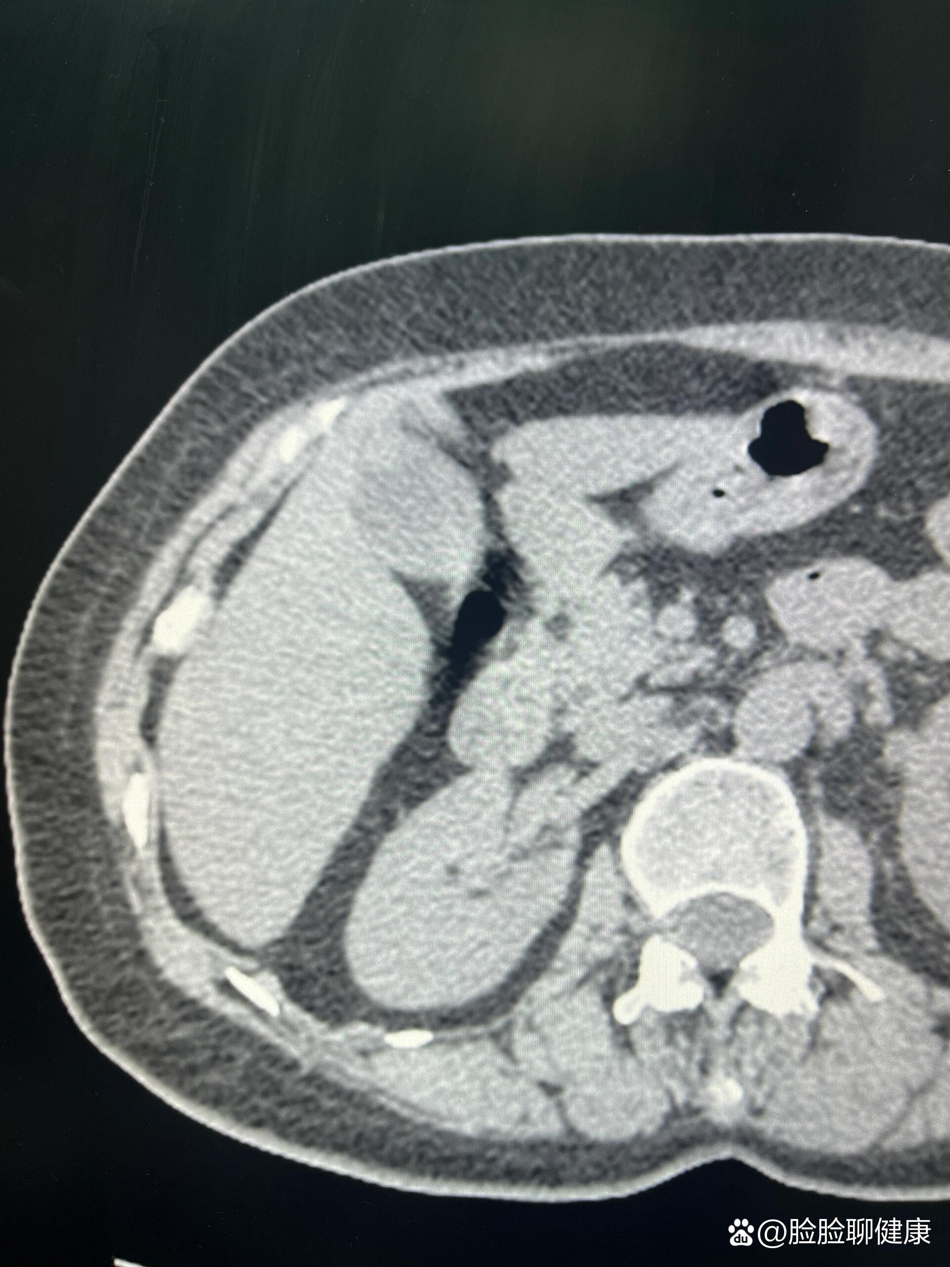 胆囊底部局限性增厚:胆囊腺肌症