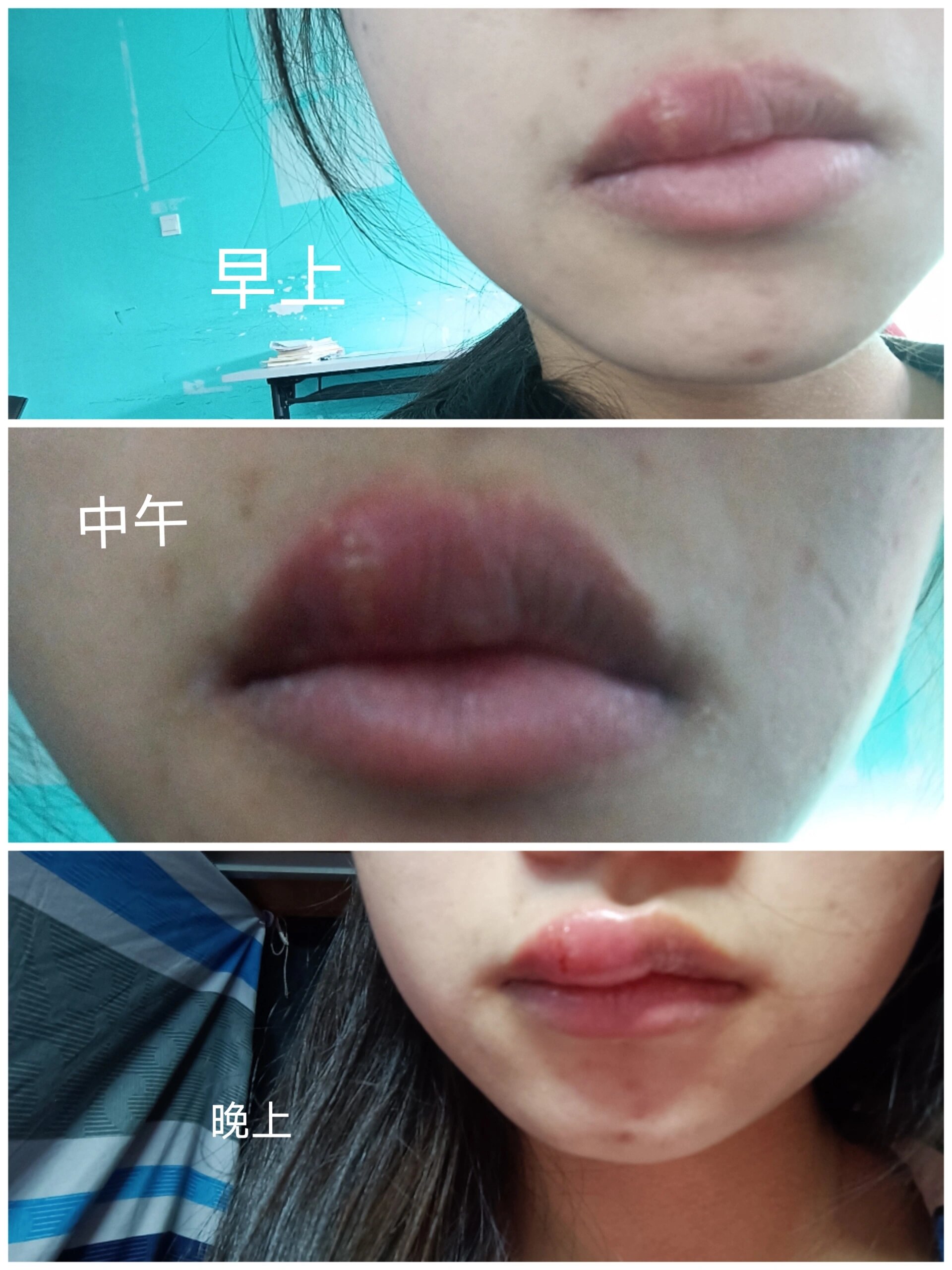 嘴唇肿的越来越厉害了咋办😞