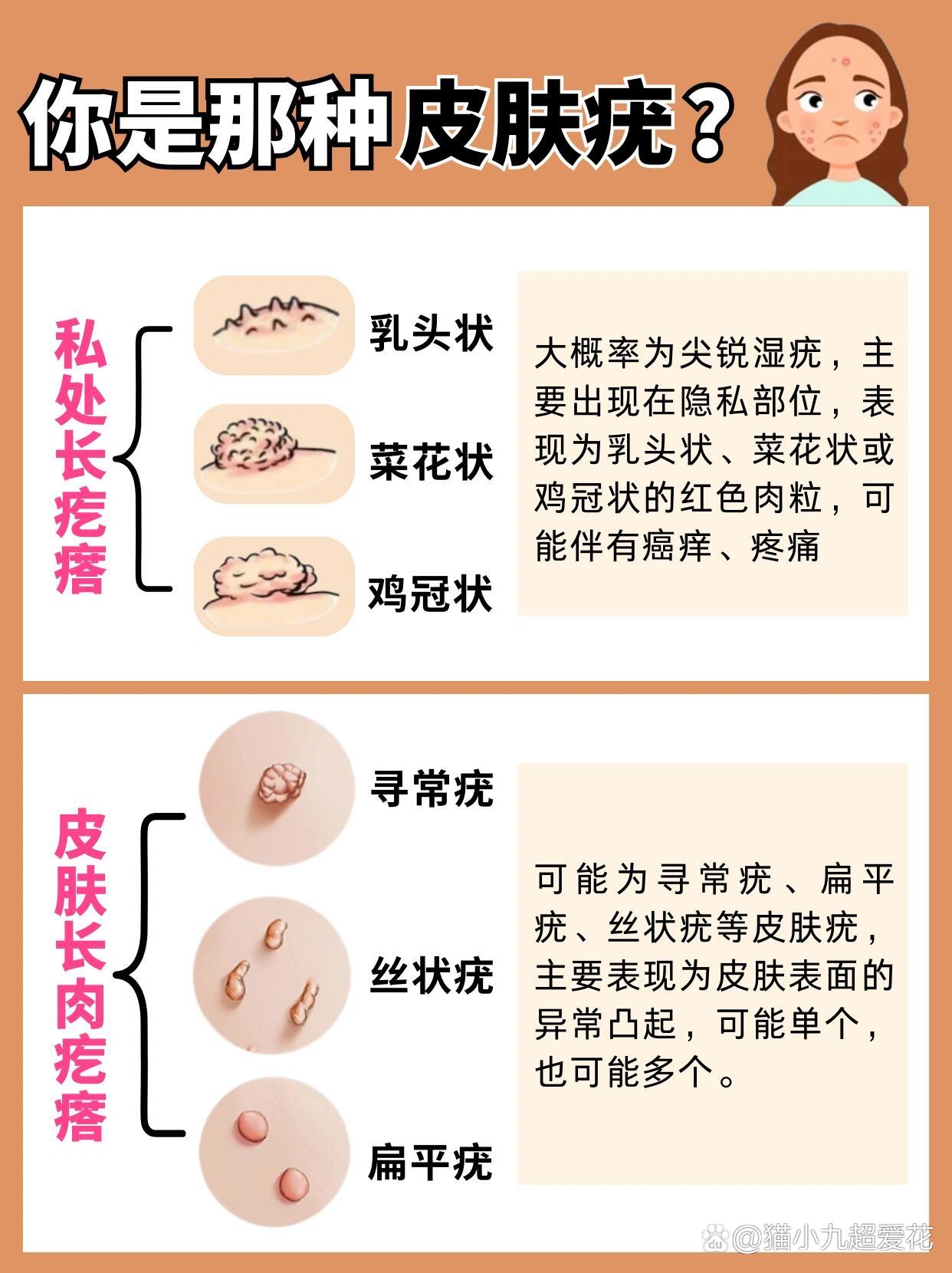 疣有几种类型图片图片