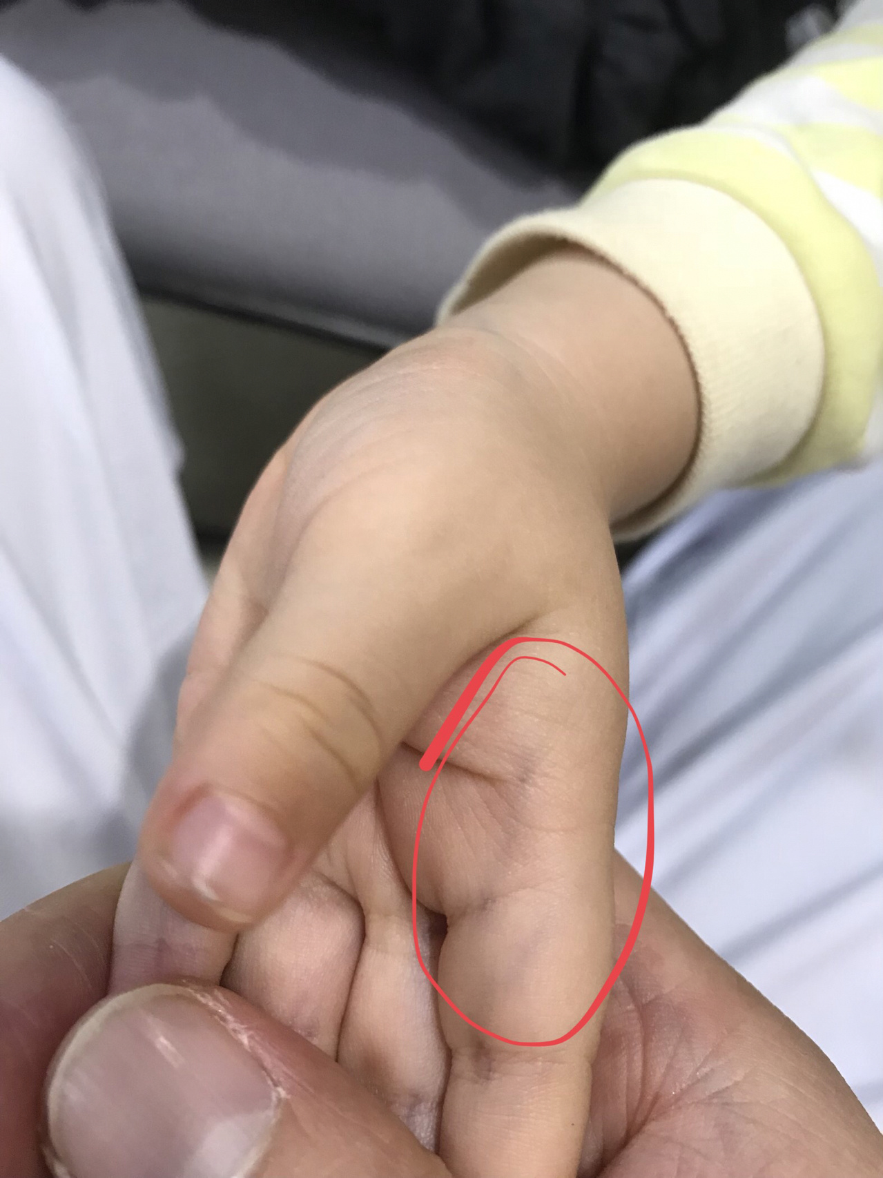 小儿指纹色紫红,家长要当心
