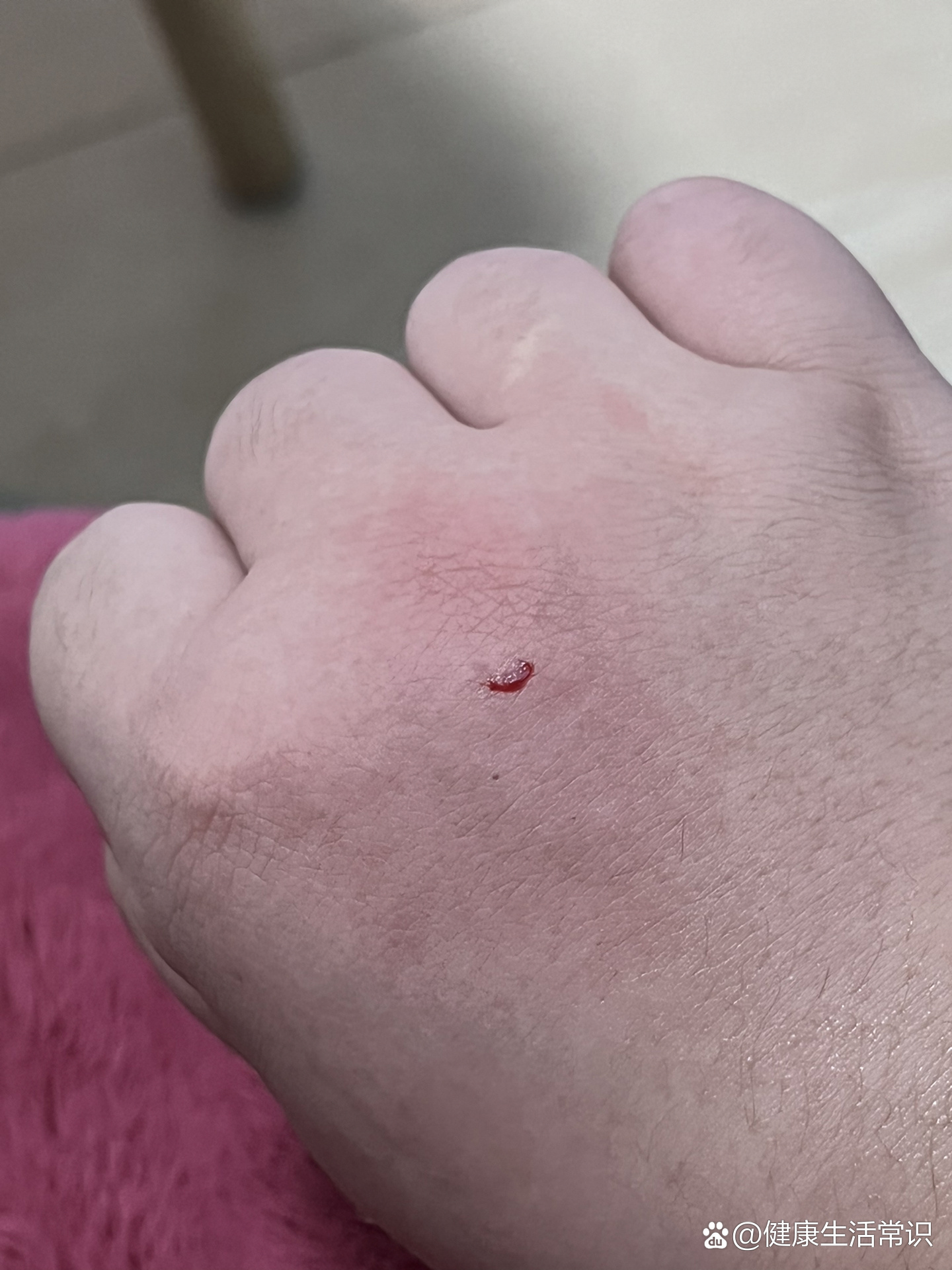 自己家的宠物狗咬到了,需要打疫苗吗