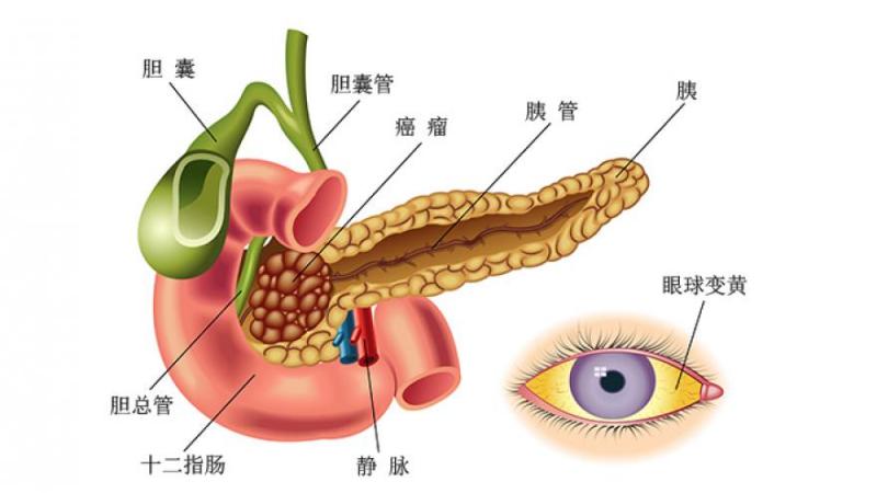 胰腺癌的症状有哪些