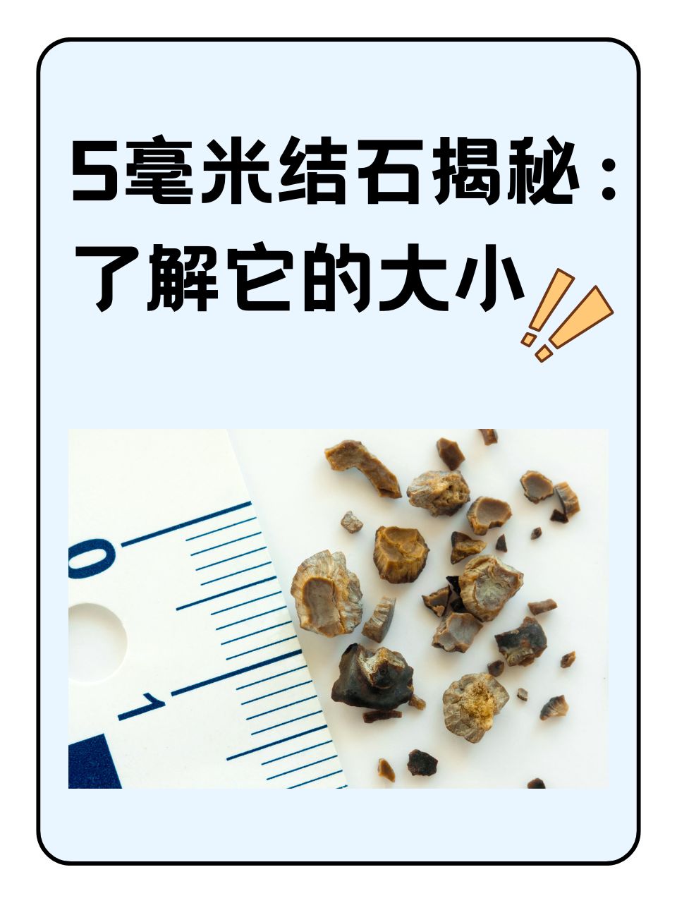 那么,5毫米的结石究竟有多大?5毫米的结石相当于绿豆粒大小