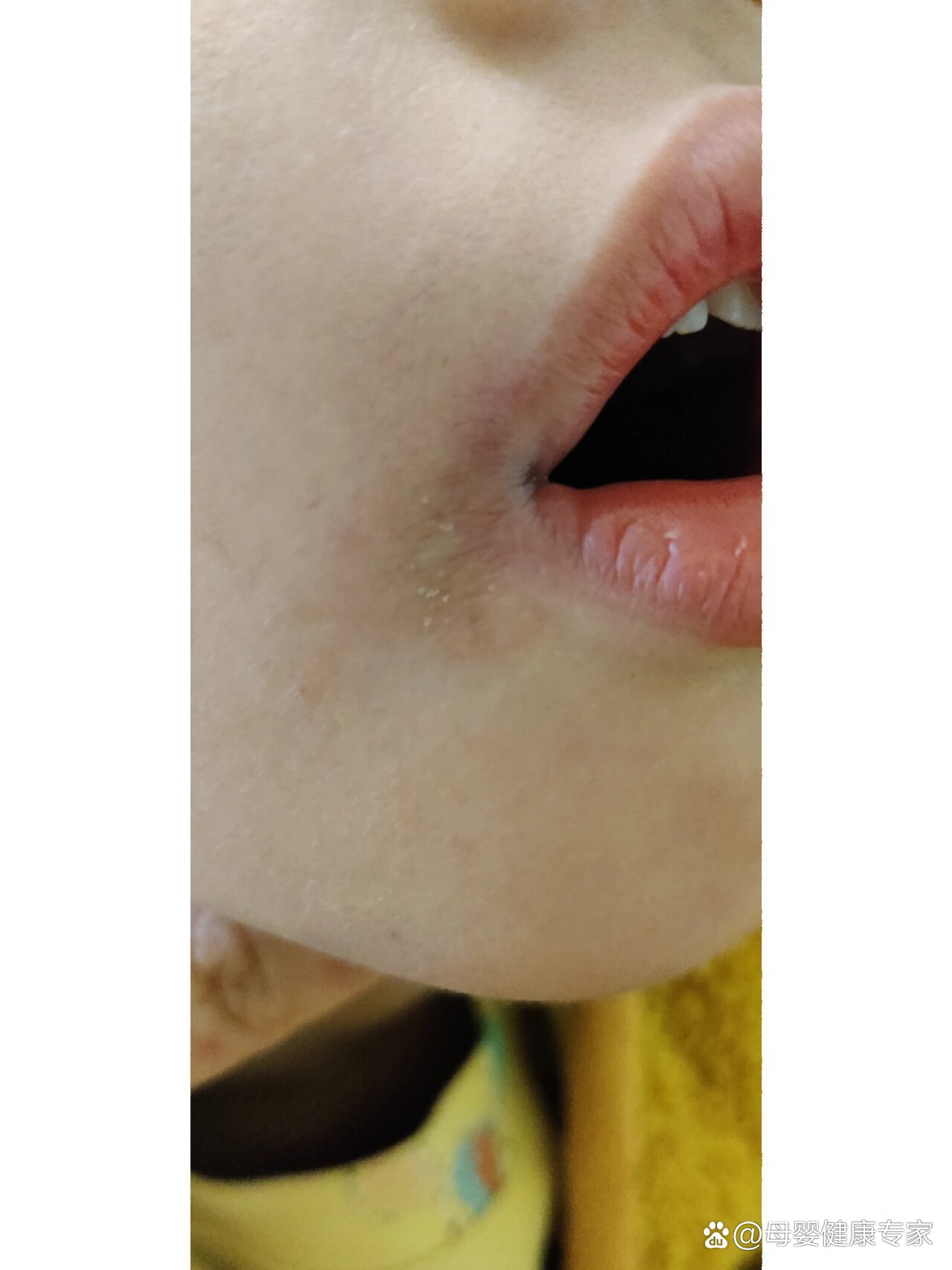 儿童嘴角黑黑的,有点粗糙是什么情况啊?