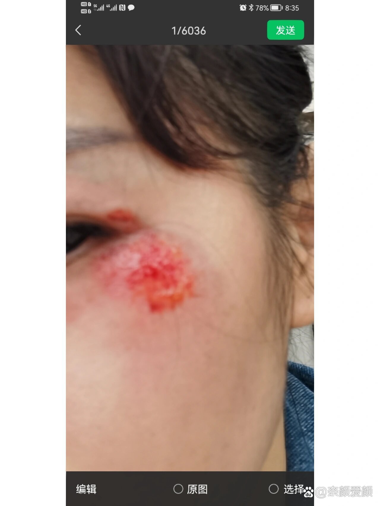 骑电动车摔伤了脸,希望不要留疤