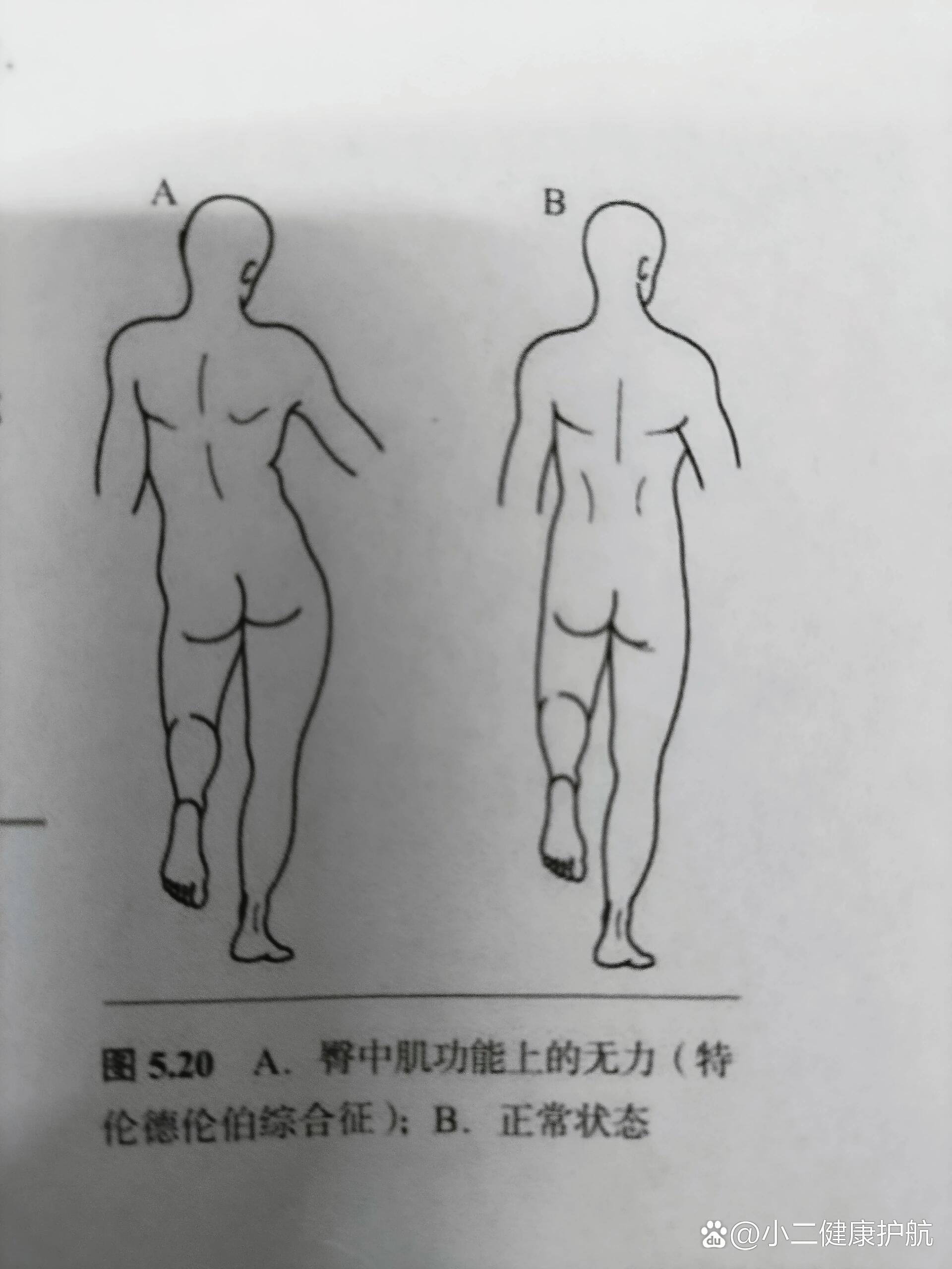 改正瘸走路姿势图片