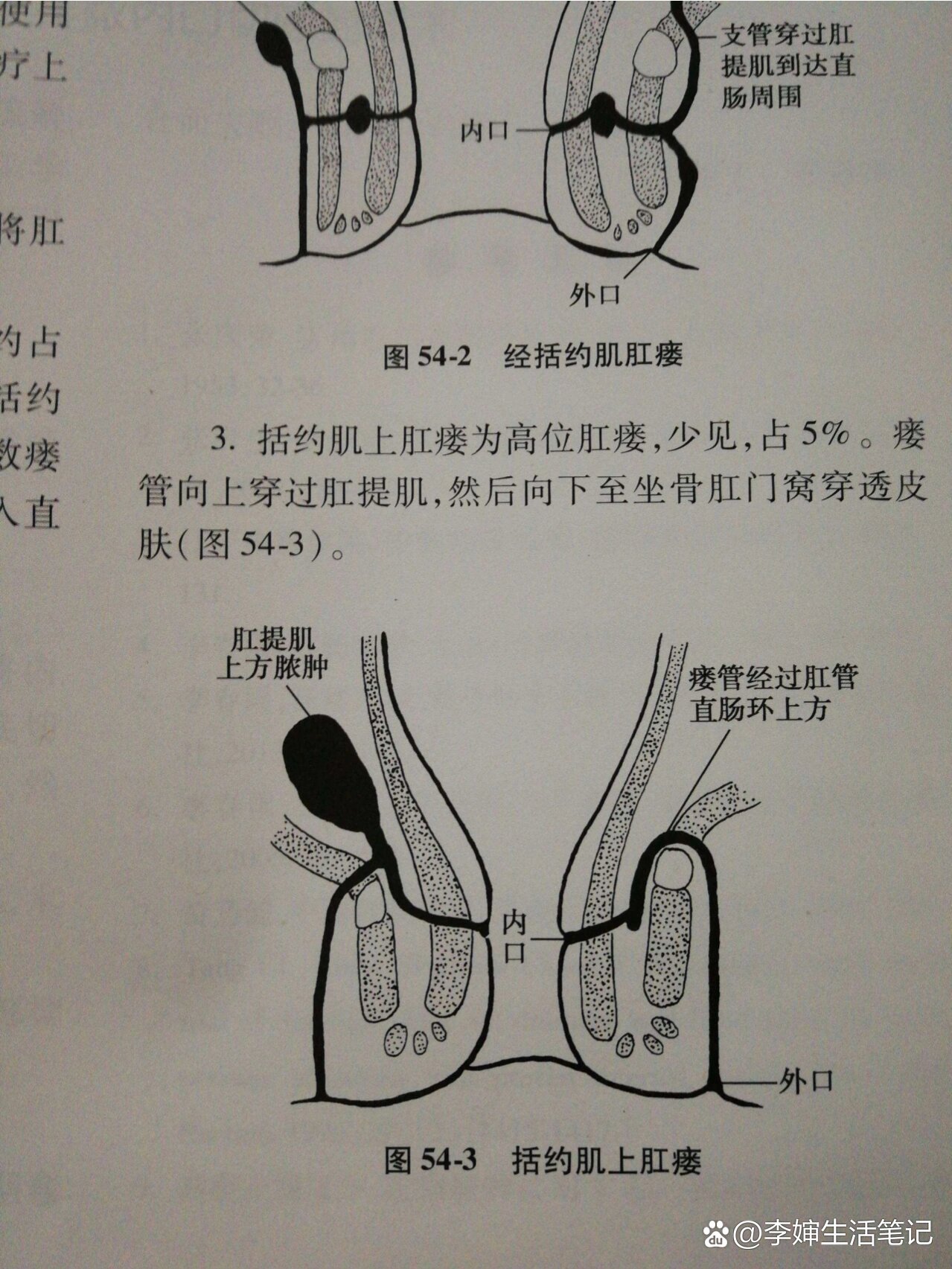 肛瘘手术大概多少钱图片