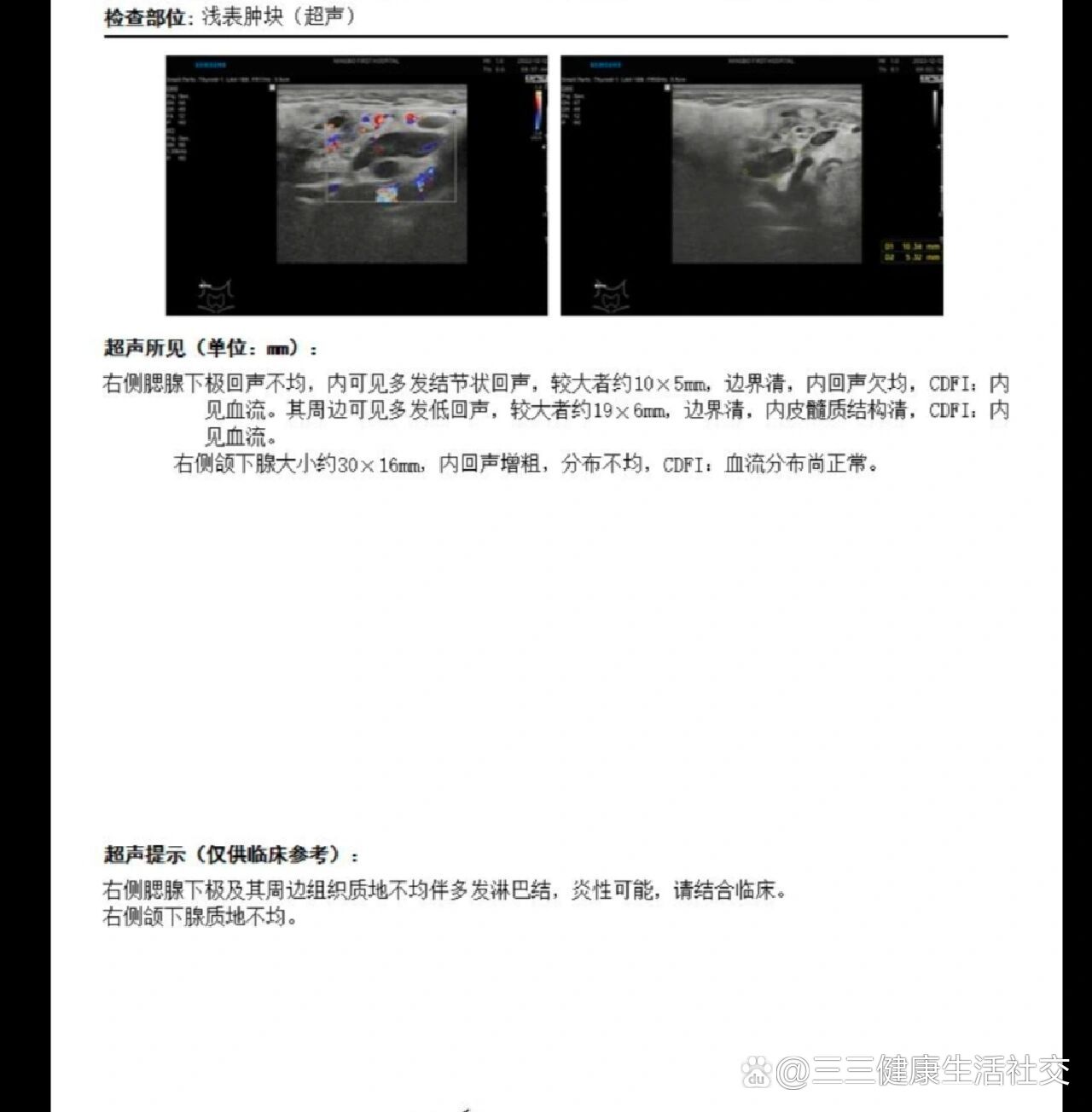 腮腺下级和颌下腺上处的区域多发淋巴结肿大