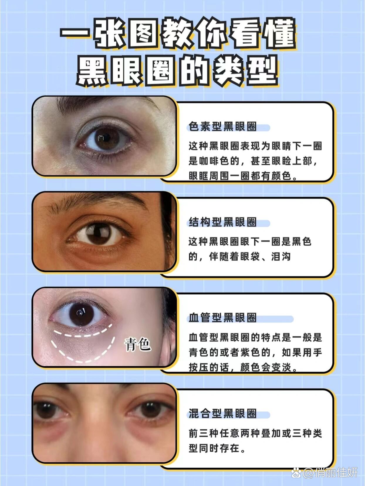 各种类型的黑眼圈图片图片