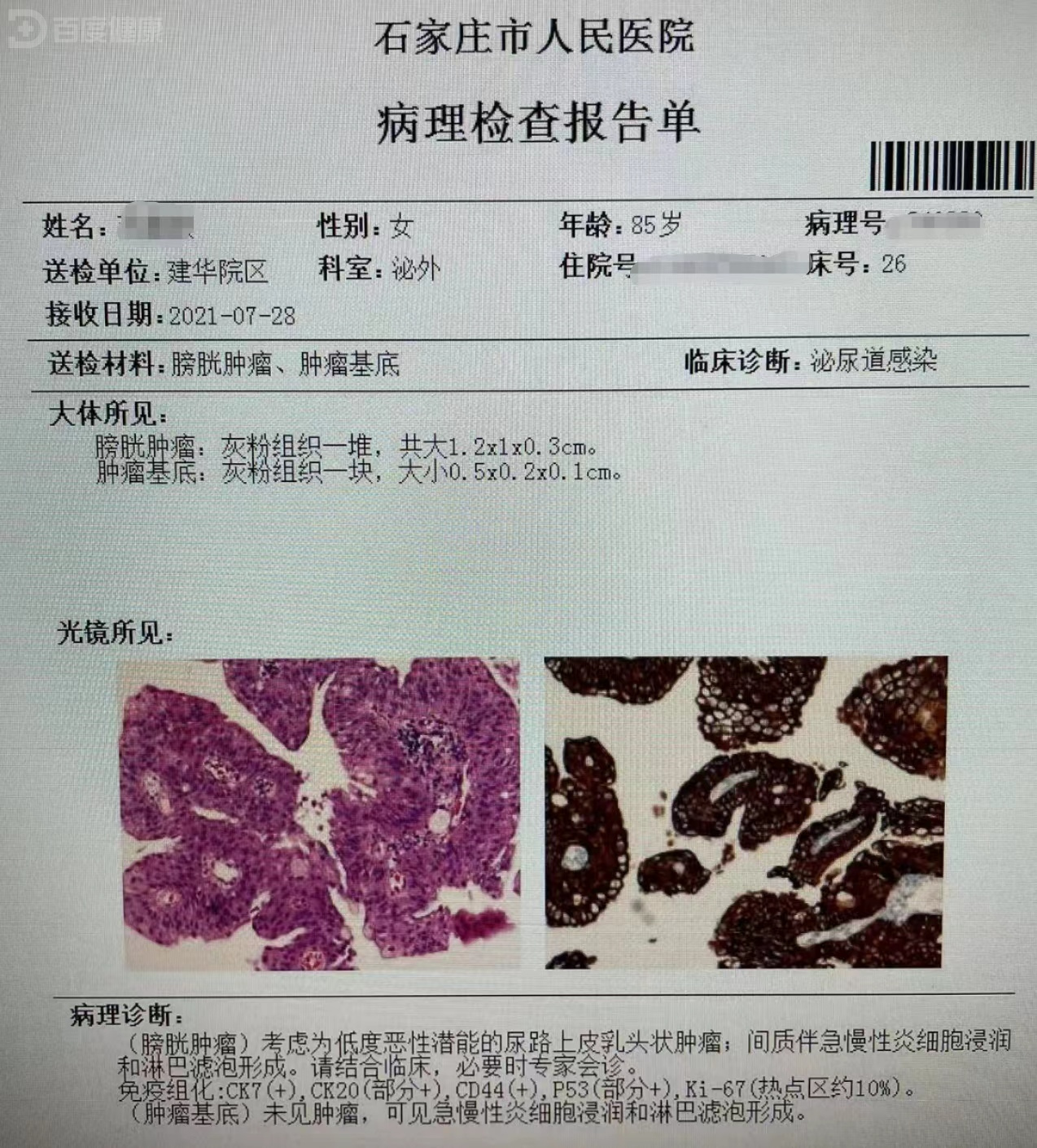 膀胱癌 病理报告图片