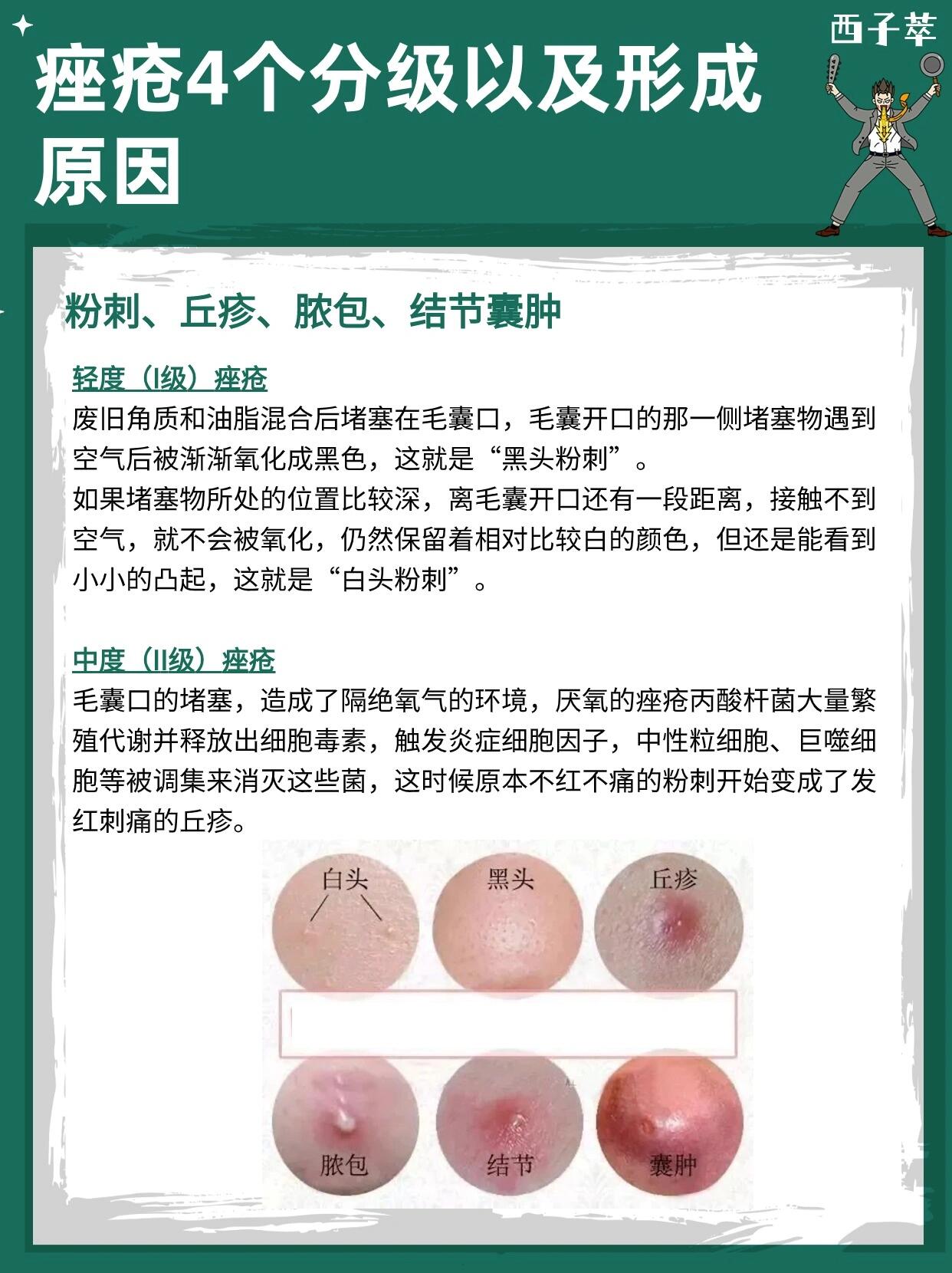 痤疮4个分级以及形成原因