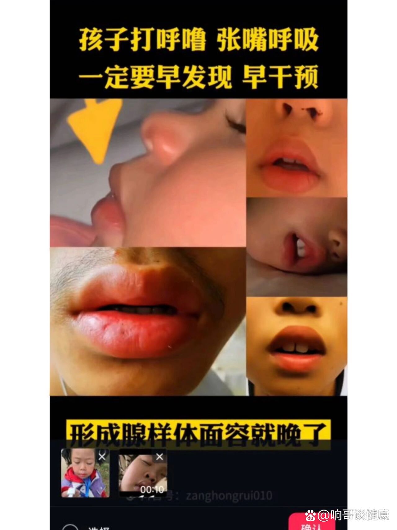 鼻炎的孩子最容易形成腺样体面容,就是鼻梁骨扁平,鼻尖回缩,上下口唇