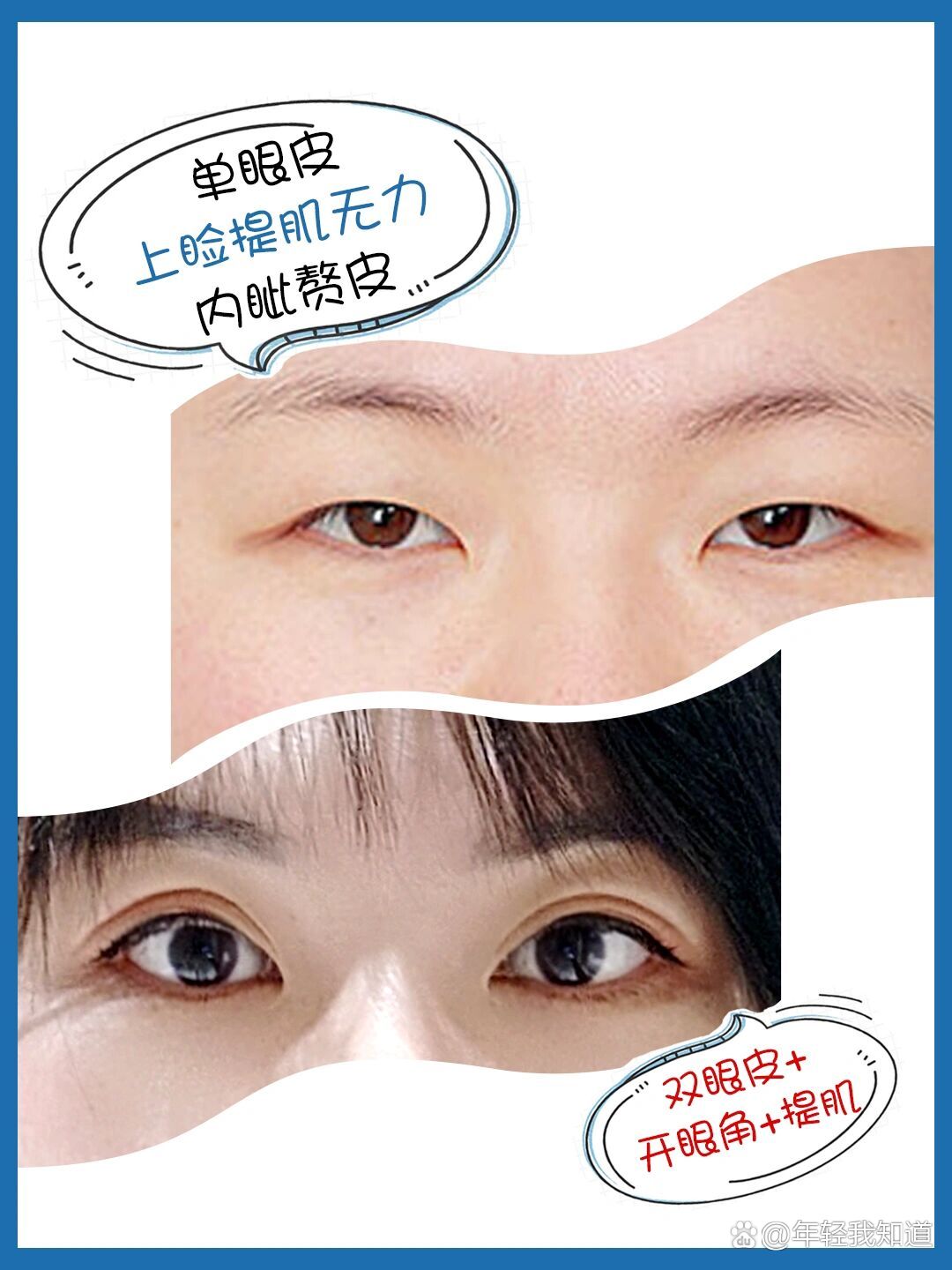 do双眼皮前,先了解一下提肌