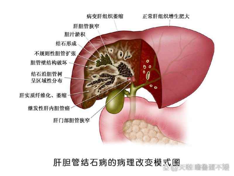 肝内胆管结石如果结石较多影响肝功能是需要早期手术处理的,有时也会