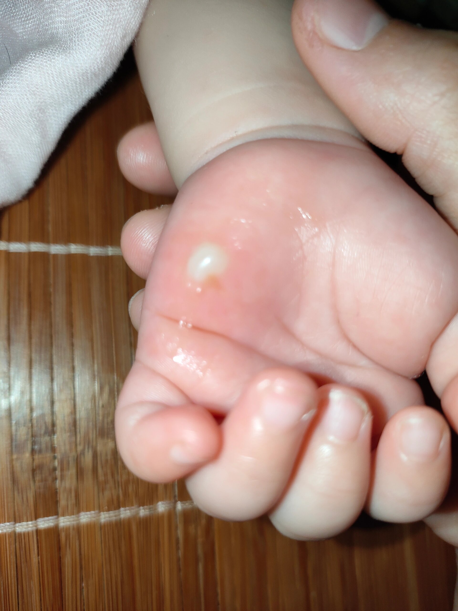 宝宝被烫伤了怎么处理,水泡要戳破吗?