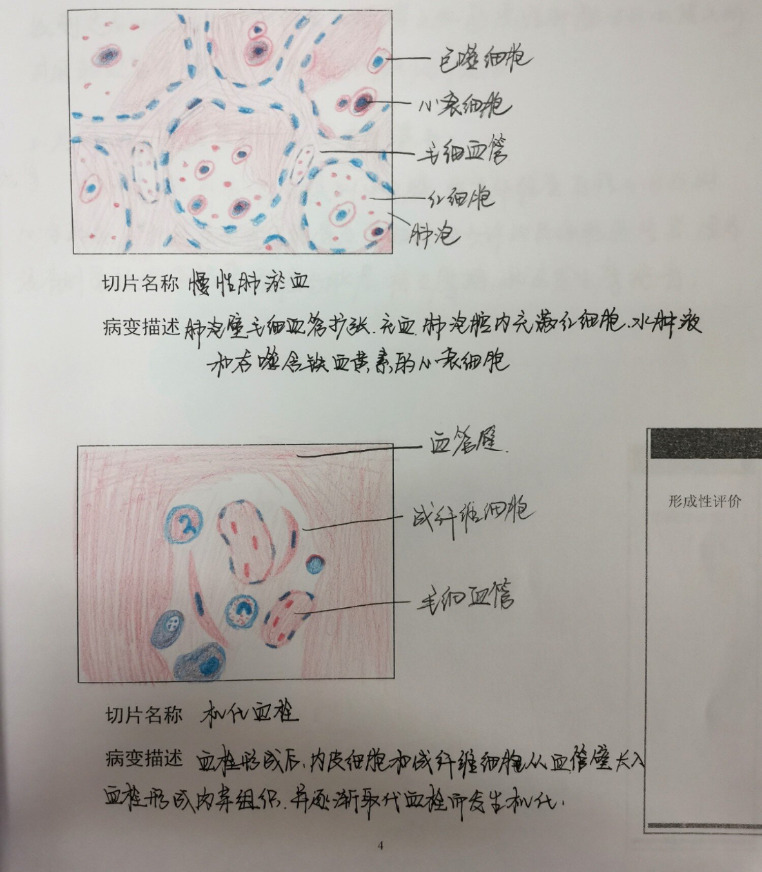 葡萄胎红蓝铅笔图图片